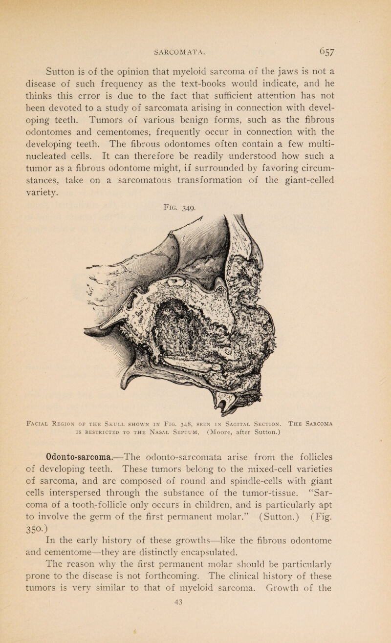 Sutton is of the opinion that myeloid sarcoma of the jaws is not a disease of such frequency as the text-books would indicate, and he thinks this error is due to the fact that sufficient attention has not been devoted to a study of sarcomata arising in connection with devel¬ oping teeth. Tumors of various benign forms, such as the fibrous odontomes and cementomes, frequently occur in connection with the developing teeth. The fibrous odontomes often contain a few multi- nucleated cells. It can therefore be readily understood how such a tumor as a fibrous odontome might, if surrounded by favoring circum¬ stances, take on a sarcomatous transformation of the giant-celled variety. Fig. 349. Facial Region of the Skull shown in Fig. 348, seen in Sagital Section. The Sarcoma is restricted to the Nasal Septum. (Moore, after Sutton.) Odonto-sarcoma.—The odonto-sarcomata arise from the follicles of developing teeth. These tumors belong to the mixed-cell varieties of sarcoma, and are composed of round and spindle-cells with giant cells interspersed through the substance of the tumor-tissue. “Sar¬ coma of a tooth-follicle only occurs in children, and is particularly apt to involve the germ of the first permanent molar.” (Sutton.) (Fig. 350-) In the early history of these growths—like the fibrous odontome and cementome—they are distinctly encapsulated. The reason why the first permanent molar should be particularly prone to the disease is not forthcoming. The clinical history of these tumors is very similar to that of myeloid sarcoma. Growth of the 43