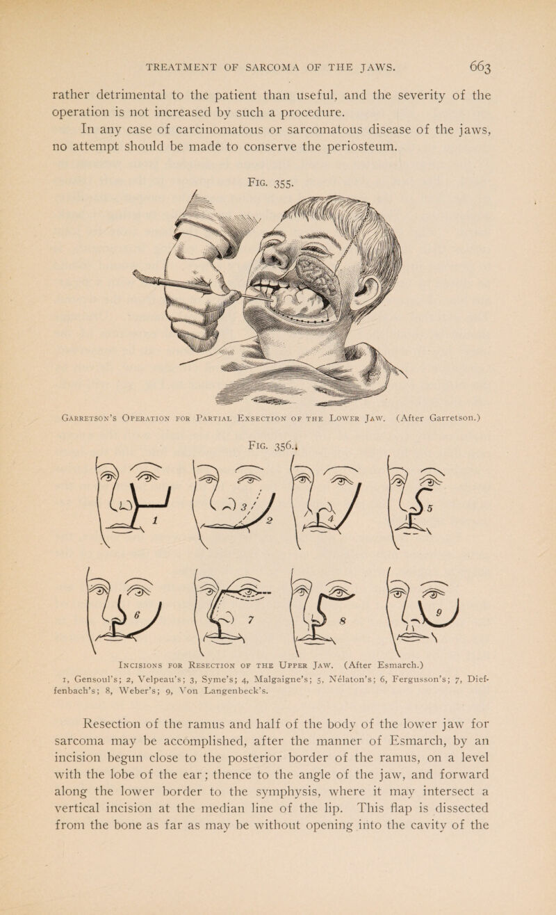 rather detrimental to the patient than useful, and the severity of the operation is not increased by such a procedure. In any case of carcinomatous or sarcomatous disease of the jaws, no attempt should be made to conserve the periosteum. Fig. 355. Garretson’s Operation for Partial Exsection of the Lower Jaw. (After Garretson.) Incisions for Resection of the Upper Jaw. (After Esmarch.) 1, Gensoul’s; 2, Velpeau’s; 3, Syme’s; 4, Malgaigne’s; 5, Nelaton’s; 6, Fergusson’s; 7, Dief- fenbach’s; 8, Weber’s; 9, Von Langenbeck’s. Resection of the ramus and half of the body of the lower jaw for sarcoma may be accomplished, after the manner of Esmarch, by an incision begun close to the posterior border of the ramus, on a level with the lobe of the ear; thence to the angle of the jaw, and forward along the lower border to the symphysis, where it may intersect a vertical incision at the median line of the lip. This flap is dissected from the bone as far as may be without opening into the cavity of the