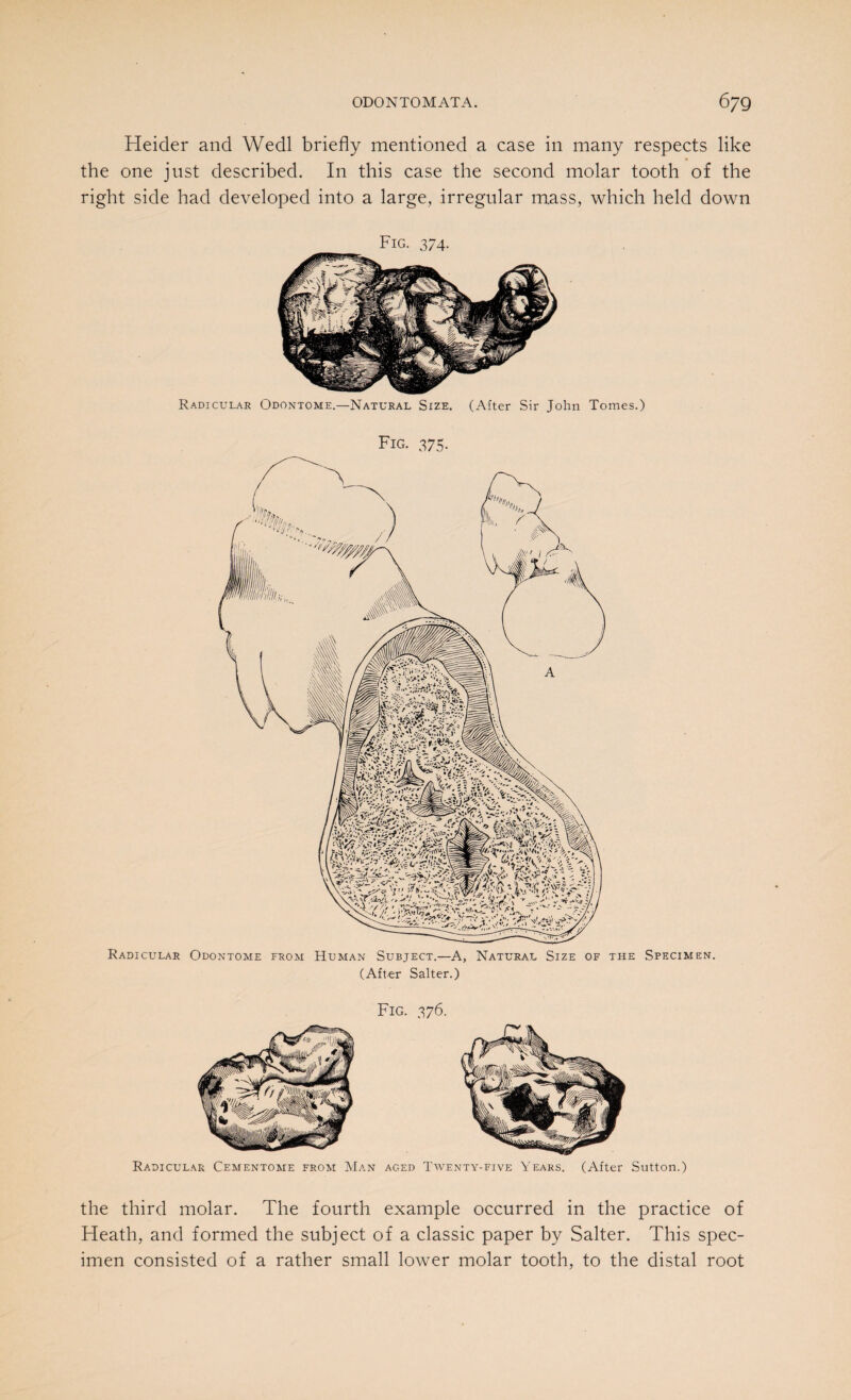 Heider and Wedl briefly mentioned a case in many respects like the one just described. In this case the second molar tooth of the right side had developed into a large, irregular mass, which held down Fig. 374. Radicular Odontome.—Natural Size. (After Sir John Tomes.) Fig. 375. Radicular Odontome from Human Subject.—A, Natural Size of the Specimen. (After Salter.) Fig. 376. Radicular Cementome from Man aged Twenty-five Years. (After Sutton.) the third molar. The fourth example occurred in the practice of Heath, and formed the subject of a classic paper by Salter. This spec¬ imen consisted of a rather small lower molar tooth, to the distal root