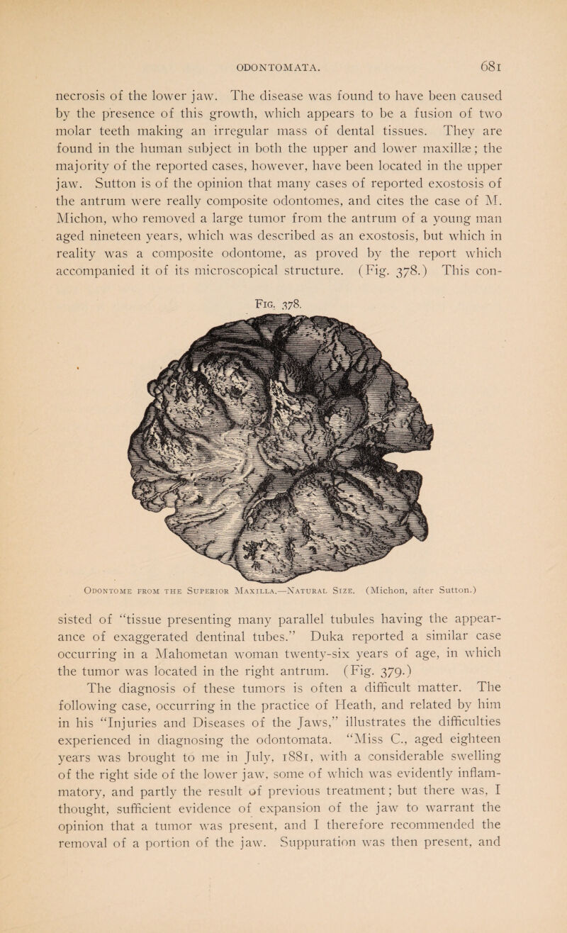 necrosis of the lower jaw. The disease was found to have been caused by the presence of this growth, which appears to be a fusion of two molar teeth making an irregular mass of dental tissues. They are found in the human subject in both the upper and lower maxillae; the majority of the reported cases, however, have been located in the upper jaw. Sutton is of the opinion that many cases of reported exostosis of the antrum were really composite odontomes, and cites the case of M. Michon, who removed a large tumor from the antrum of a young man aged nineteen years, which was described as an exostosis, but which in reality was a composite odontome, as proved by the report which accompanied it of its microscopical structure. (Fig. 378.) This con- Fig. 378. Odontome from the Superior Maxilla.—Natural Size. (Michon, after Sutton.) sisted of “tissue presenting many parallel tubules having the appear¬ ance of exaggerated dentinal tubes.” Duka reported a similar case occurring in a Mahometan woman twenty-six years of age, in which the tumor was located in the right antrum. (Fig. 379-) The diagnosis of these tumors is often a difficult matter. The following case, occurring in the practice of Heath, and related by him in his “Injuries and Diseases of the Jaws, illustrates the difficulties experienced in diagnosing the odontomata. “Miss C., aged eighteen years was brought to me in July, 1881, with a considerable swelling of the right side of the lower jaw, some of which was evidently inflam¬ matory, and partly the result of previous treatment; but there was, I thought, sufficient evidence of expansion of the jaw to warrant the opinion that a tumor was present, and I therefore recommended the removal of a portion of the jaw. Suppuration was then present, and