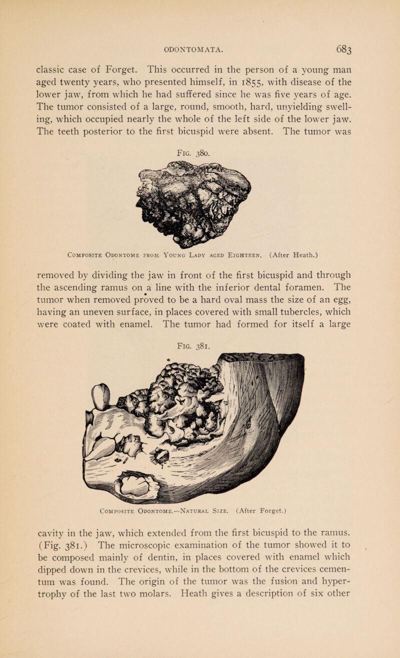 classic case of Forget. This occurred in the person of a young man aged twenty years, who presented himself, in 1855, with disease of the lower jaw, from which he had suffered since he was five years of age. The tumor consisted of a large, round, smooth, hard, unyielding swell¬ ing, which occupied nearly the whole of the left side of the lower jaw. The teeth posterior to the first bicuspid were absent. The tumor was Fig. 380. Composite Odontome from Young Lady aged Eighteen. (After Heath.) removed by dividing the jaw in front of the first bicuspid and through the ascending ramus on a line with the inferior dental foramen. The # tumor when removed proved to be a hard oval mass the size of an egg, having an uneven surface, in places covered with small tubercles, which were coated with enamel. The tumor had formed for itself a large Fig. 381. Composite Odontome.—Natural Size. (After Forget.) cavity in the jaw, which extended from the first bicuspid to the ramus. (Fig. 381.) The microscopic examination of the tumor showed it to be composed mainly of dentin, in places covered with enamel which dipped down in the crevices, while in the bottom of the crevices cemen- tum was found. The origin of the tumor was the fusion and hyper¬ trophy of the last two molars. Heath gives a description of six other