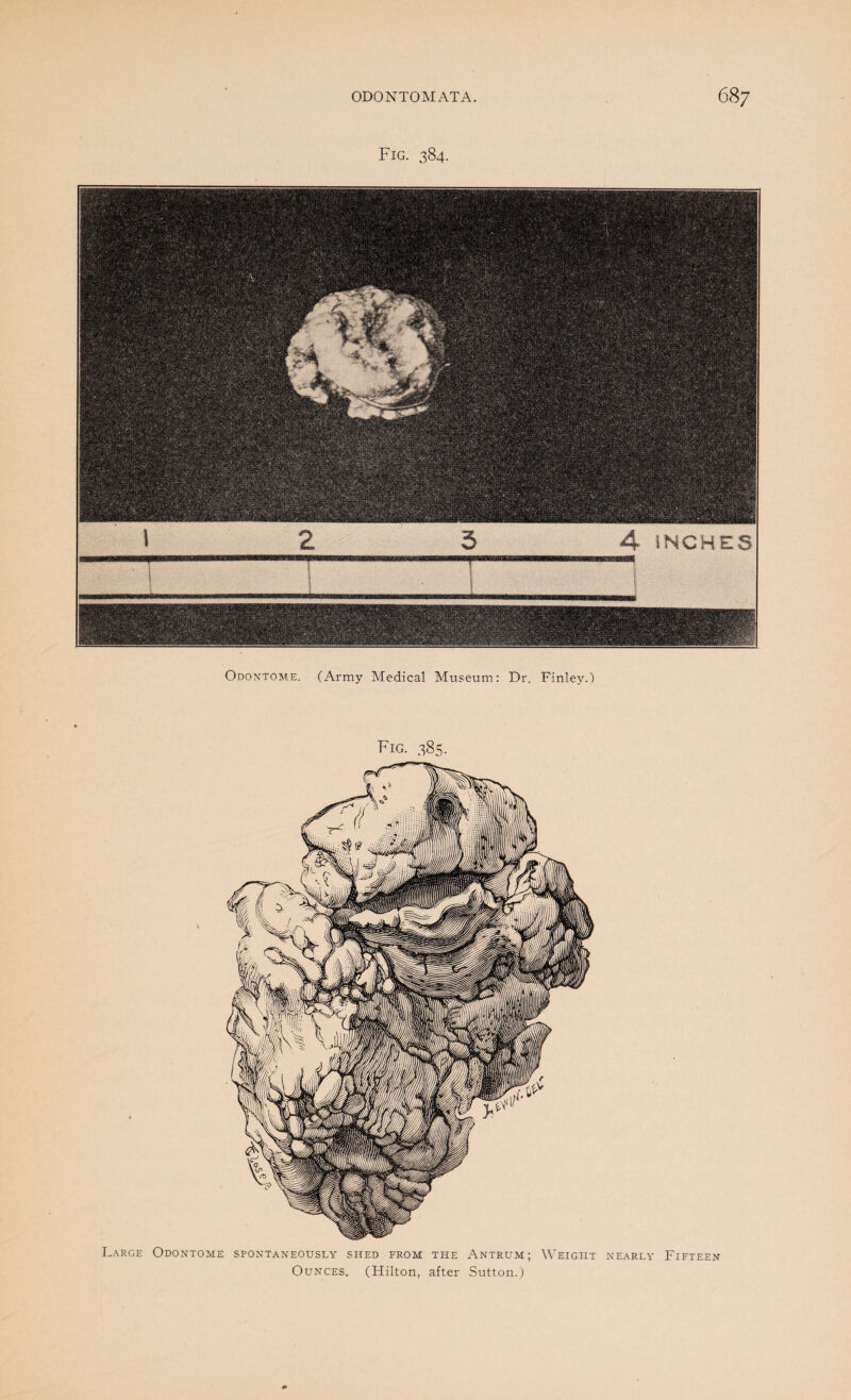 Fig. 384. Odontome. (Army Medical Museum: Dr. Finley.) Large Fig. 385. Odontome spontaneously shed from the Antrum; Weight Ounces. (Hilton, after Sutton.) NEARLY Fifteen