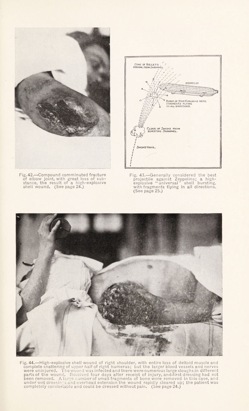 Fig. 4-2.—Compound comminuted fracture of elbow joint, with great loss of sub¬ stance, the result of a high-explosive shell wound. (See page 24.) Fig. 43.—Generally considered the best projectile against Zeppelins; a high- explosive “universal” shell bursting, with fragments flying in all directions. (See page 25.) Fig. 44.— High-explosive shell wound of right shoulder, with entire loss of deltoid muscle and complete shattering of upper half of right humerus; but the larger blood vessels and nerves were uninjured. The wound was infected and there were numerous large sloughs in different parts of the wound. Received four days after receipt of injury, and-first dressing had not been removed. A large number of small fragments of bone were removed in this case, and under wet dressings and overhead extension the wound rapidly cleared up; the patient was completely comfortable and could be dressed without pain. (See page 24.)