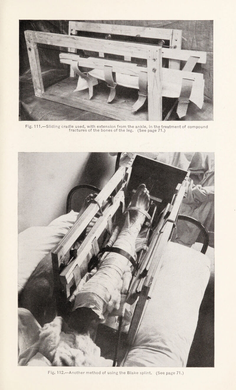 Fig. Ill.—Sliding cradle used, with extension from the ankle, in the treatment of compound f ractures of the bones of the leg. (See page 71.)