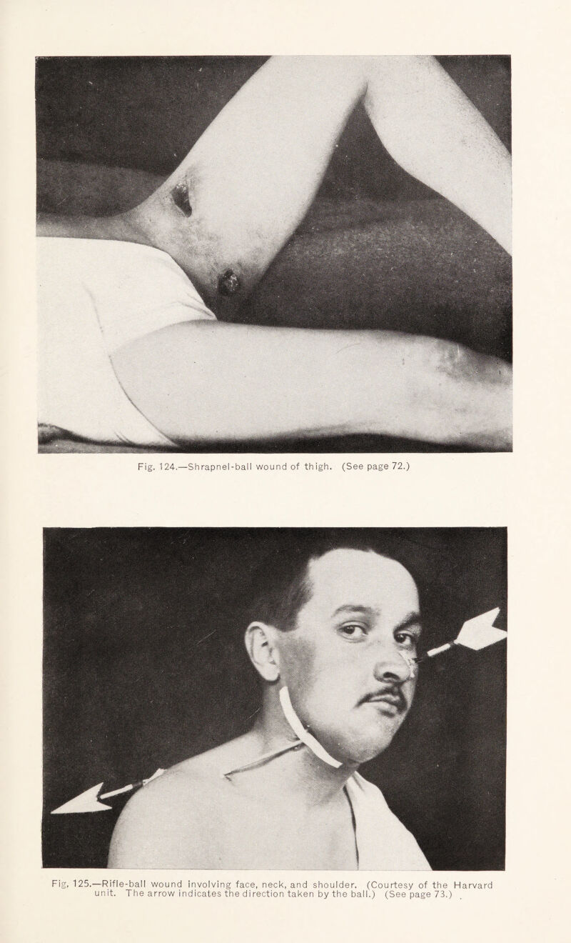 Fig, 125.—Rifle-ball wound involving face, neck, and shoulder. (Courtesy of the Harvard unit. The arrow indicates the direction taken by the ball.) (See page 73.)