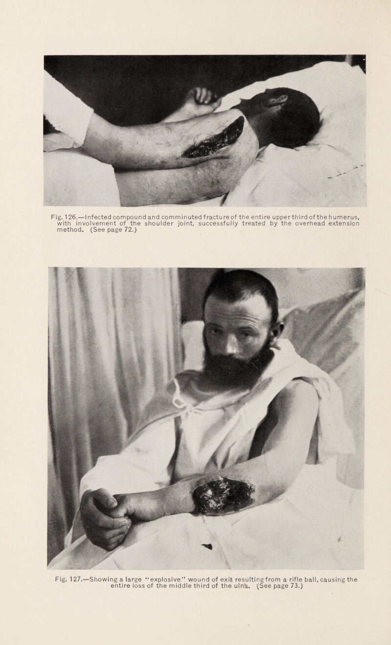 Fig. 126.— I nfected compound and com min uted f ractu re of the entire upperthirdofthehumerus, with involvement of the shoulder joint, successfully treated by the overhead extension method. (See page 72.) Fig. 127.—Showing a large “ explosive” wound of exit resulting from a rifle ball, causing the