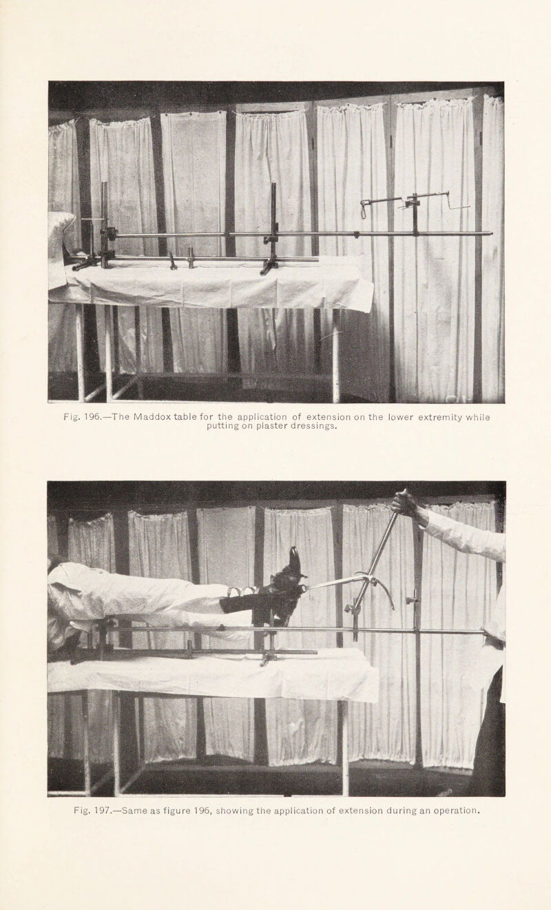 Fig. 196.—The Maddox table for the application of extension on the lower extremity while putting on plaster dressings. Fig. 197.—Same as figure 196, showing the application of extension during an operation