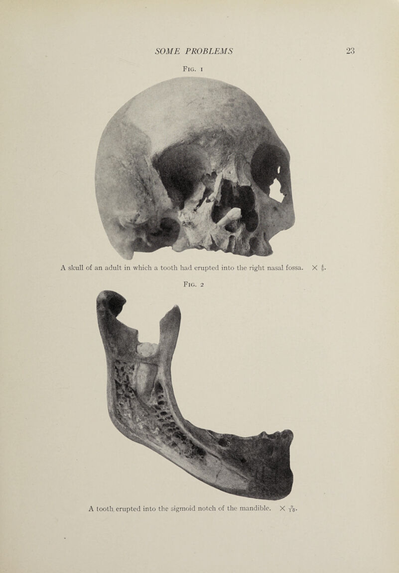 Fig. i A tooth erupted into the sigmoid notch of the mandible. X 1%. A skull of an adult in which a tooth had erupted into the right nasal fossa. X Fig. 2