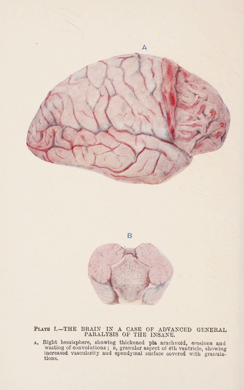 B 4 % mm mam ^J|| Mr; Plate I.—THE BRAIN IN A CASE OF ADVANCED GENERAL PARALYSIS OF THE INSANE. A, Right hemisphere, showing thickened pia arachnoid, erosions and wasting of convolutions ; b, granular aspect of 4th ventricle, showing increased vascularity and ependymal surface covered with granula¬ tions.