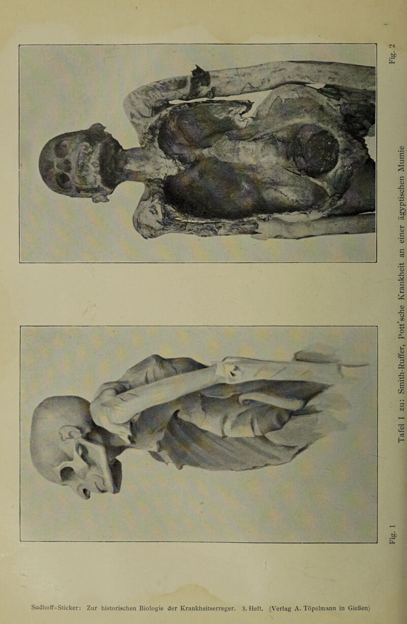 Sudhoff-Sticker: Zur historischen Biologie der Krankheitserreger. 3. Heft. (Verlag A. Töpelmann in Gießen) Tafel I zu: Smith-Ruffer, Pott’sche Krankheit an einer ägyptischen Mumie