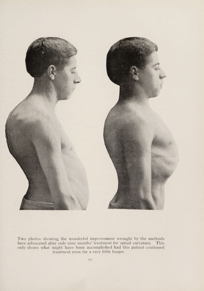 Two photos showing the wonderful improvement wrought by the methods here advocated after only nine months’ treatment for spinal curvature. This only shows what might have been accomplished had this patient continued treatment even for a very little longer.