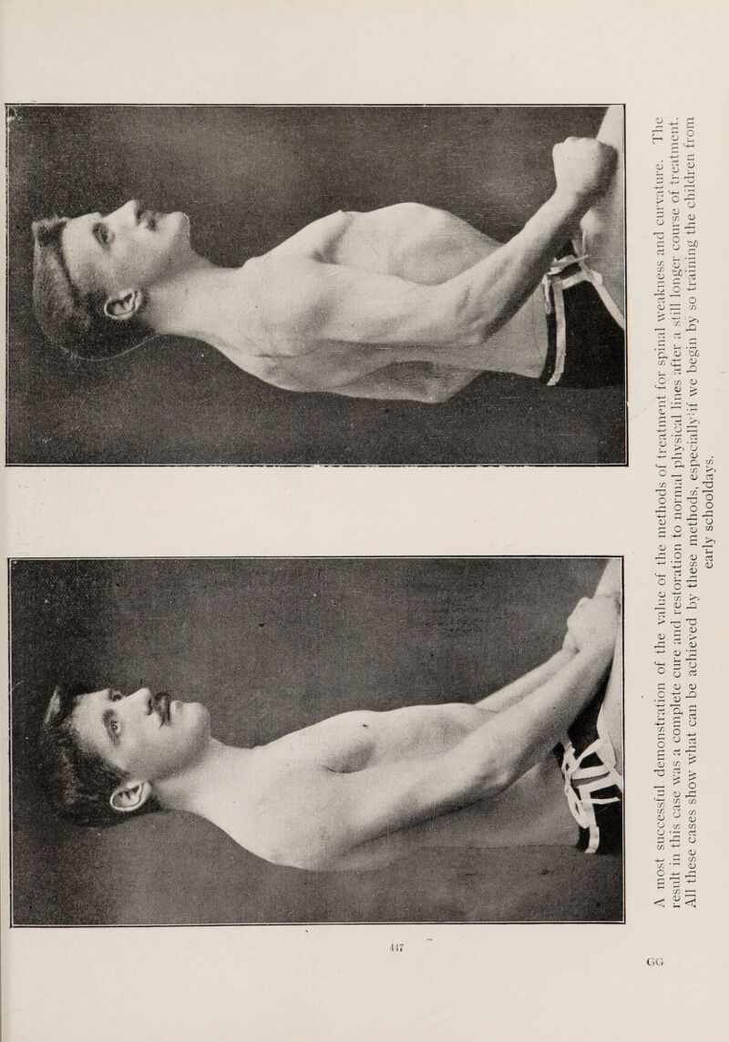 GG A most successful demonstration of the value of the methods of treatment for spinal weakness and curvature. The result in this case was a complete cure and restoration to normal physical lines after a still longer course of treatment. All these cases show what can be achieved by these methods, especiallyhf we begin by so training the children from early schooldays.