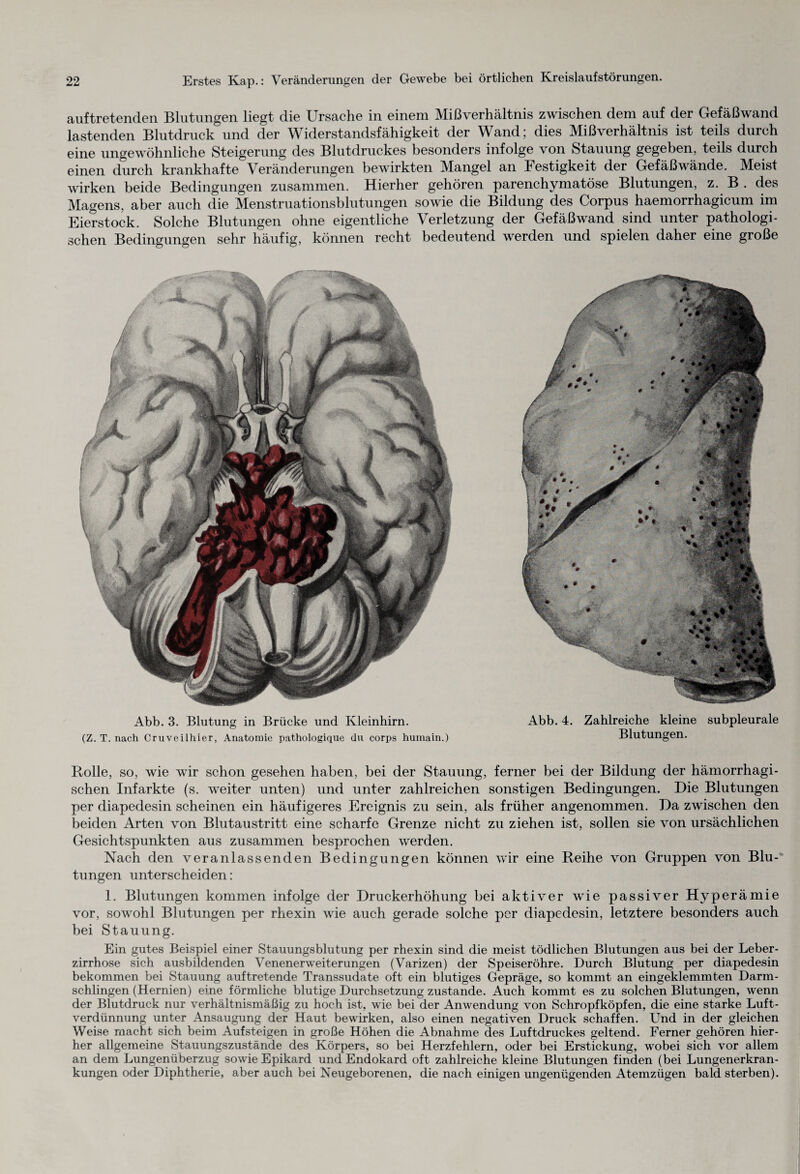 auftretenden Blutungen liegt die Ursache in einem Mißverhältnis zwischen dem auf der Gefäßwand lastenden Blutdruck und der Widerstandsfähigkeit der Wand; dies Mißverhältnis ist teils durch eine ungewöhnliche Steigerung des Blutdruckes besonders infolge von Stauung gegeben, teils durch einen durch krankhafte Veränderungen bewirkten Mangel an Festigkeit der Gefäßwände. Meist wirken beide Bedingungen zusammen. Hierher gehören parenchymatöse Blutungen, z. B . des Magens, aber auch die Menstruationsblutungen sowie die Bildung des Corpus haemorrhagicum im Eierstock. Solche Blutungen ohne eigentliche Verletzung der Gefäßwand sind unter pathologi¬ schen Bedingungen sehr häufig, können recht bedeutend werden und spielen daher eine große Abb. 3. Blutung in Brücke und Kleinhirn. (Z. T. nach Cruveilhier, Anatomie pathologique du corps humain.) Abb. 4. Zahlreiche kleine subpleurale Blutungen. Rolle, so, wie wir schon gesehen haben, bei der Stauung, ferner bei der Bildung der hämorrhagi¬ schen Infarkte (s. weiter unten) und unter zahlreichen sonstigen Bedingungen. Die Blutungen per diapedesin scheinen ein häufigeres Ereignis zu sein, als früher angenommen. Da zwischen den beiden Arten von Blutaustritt eine scharfe Grenze nicht zu ziehen ist, sollen sie von ursächlichen Gesichtspunkten aus zusammen besprochen werden. Nach den veranlassenden Bedingungen können wir eine Reihe von Gruppen von Blu¬ tungen unterscheiden: 1. Blutungen kommen infolge der Druckerhöhung bei aktiver wie passiver Hyperämie vor, sowohl Blutungen per rhexin wie auch gerade solche per diapedesin, letztere besonders auch bei Stauung. Ein gutes Beispiel einer Stauungsblutung per rhexin sind die meist tödlichen Blutungen aus bei der Leber¬ zirrhose sich ausbildenden Venenerweiterungen (Varizen) der Speiseröhre. Durch Blutung per diapedesin bekommen bei Stauung auftretende Transsudate oft ein blutiges Gepräge, so kommt an eingeklemmten Darm¬ schlingen (Hernien) eine förmliche blutige Durchsetzung zustande. Auch kommt es zu solchen Blutungen, wenn der Blutdruck nur verhältnismäßig zu hoch ist, wie bei der Anwendung von Schropfköpfen, die eine starke Luft¬ verdünnung unter Ansaugung der Haut bewirken, also einen negativen Druck schaffen. Und in der gleichen Weise macht sich beim Auf steigen in große Höhen die Abnahme des Luftdruckes geltend. Ferner gehören hier¬ her allgemeine Stauungszustände des Körpers, so bei Herzfehlern, oder bei Erstickung, wobei sich vor allem an dem Lungenüberzug sowie Epikard und Endokard oft zahlreiche kleine Blutungen finden (bei Lungenerkran¬ kungen oder Diphtherie, aber auch bei Neugeborenen, die nach einigen ungenügenden Atemzügen bald sterben).