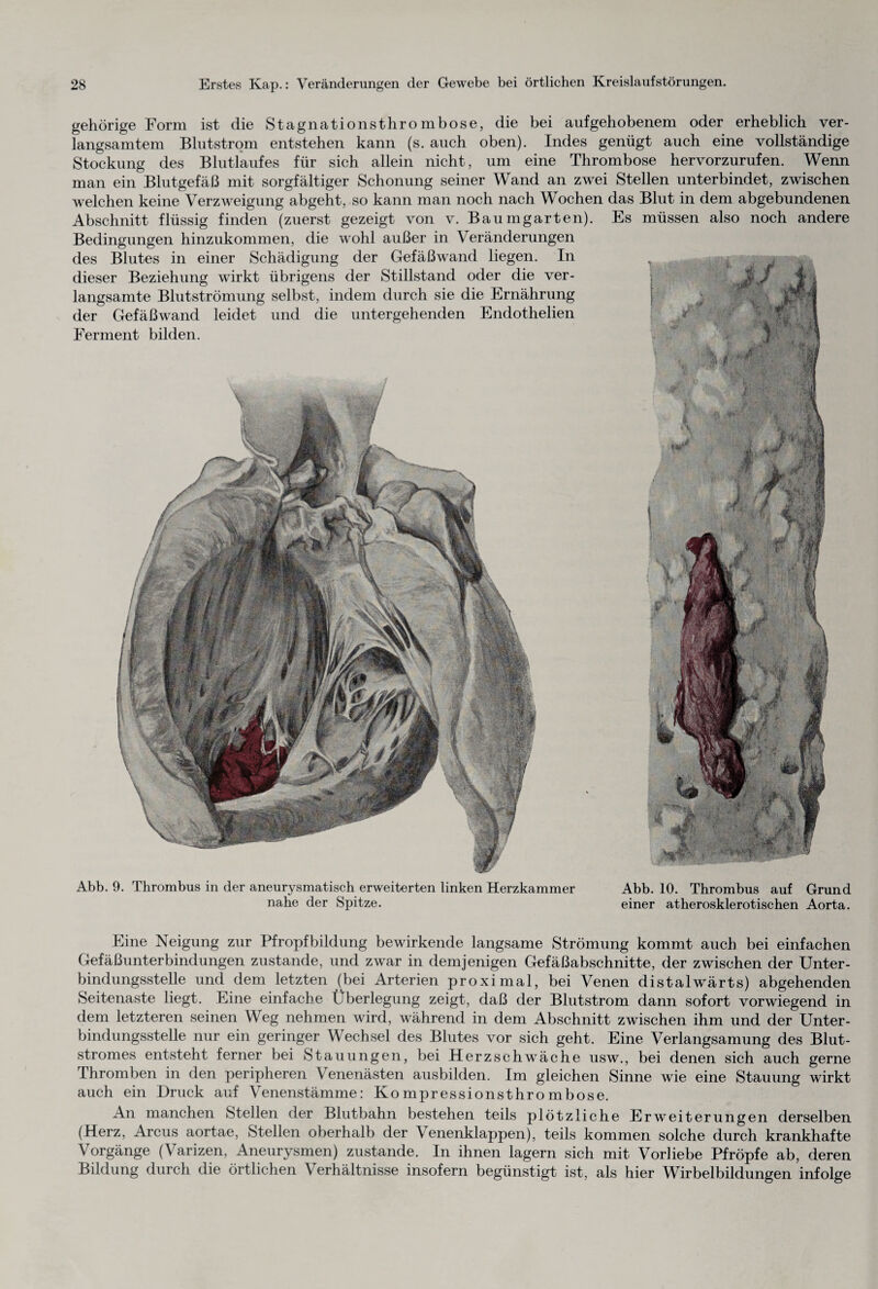 gehörige Form ist die Stagnationsthrombose, die bei aufgehobenem oder erheblich ver¬ langsamtem Blutstrom entstehen kann (s. auch oben). Indes genügt auch eine vollständige Stockung des Blutlaufes für sich allein nicht, um eine Thrombose hervorzurufen. Wenn man ein Blutgefäß mit sorgfältiger Schonung seiner Wand an zwei Stellen unterbindet, zwischen welchen keine Verzweigung abgeht, so kann man noch nach Wochen das Blut in dem abgebundenen Abschnitt flüssig finden (zuerst gezeigt von v. Baumgarten). Es müssen also noch andere Bedingungen hinzukommen, die wohl außer in Veränderungen des Blutes in einer Schädigung der Gefäßwand liegen. In dieser Beziehung wirkt übrigens der Stillstand oder die ver¬ langsamte Blutströmung selbst, indem durch sie die Ernährung der Gefäßwand leidet und die untergehenden Endothelien Ferment bilden. Abb. 9. Thrombus in der aneurysmatisch erweiterten linken Herzkammer nahe der Spitze. Abb. 10. Thrombus auf Grund einer atherosklerotischen Aorta. Eine Neigung zur Pfropfbildung bewirkende langsame Strömung kommt auch bei einfachen Gefäßunterbindungen zustande, und zwar in demjenigen Gefäßabschnitte, der zwischen der Unter¬ bindungsstelle und dem letzten (bei Arterien proximal, bei Venen distalwärts) abgehenden Seitenaste liegt. Eine einfache Überlegung zeigt, daß der Blutstrom dann sofort vorwiegend in dem letzteren seinen Weg nehmen wird, während in dem Abschnitt zwischen ihm und der Unter¬ bindungsstelle nur ein geringer Wechsel des Blutes vor sich geht. Eine Verlangsamung des Blut¬ stromes entsteht ferner bei Stauungen, bei Herzschwäche usw., bei denen sich auch gerne Thromben in den peripheren Venenästen ausbilden. Im gleichen Sinne wie eine Stauung wirkt auch ein Druck auf Venenstämme: Kompressionsthrombose. An manchen Stellen der Blutbahn bestehen teils plötzliche Erweiterungen derselben (Herz, Arcus aortae, Stellen oberhalb der Venenklappen), teils kommen solche durch krankhafte Vorgänge (Varizen, Aneurysmen) zustande. In ihnen lagern sich mit Vorliebe Pfropfe ab, deren Bildung durch die örtlichen V erhältnisse insofern begünstigt ist, als hier Wirbelbildungen infolge