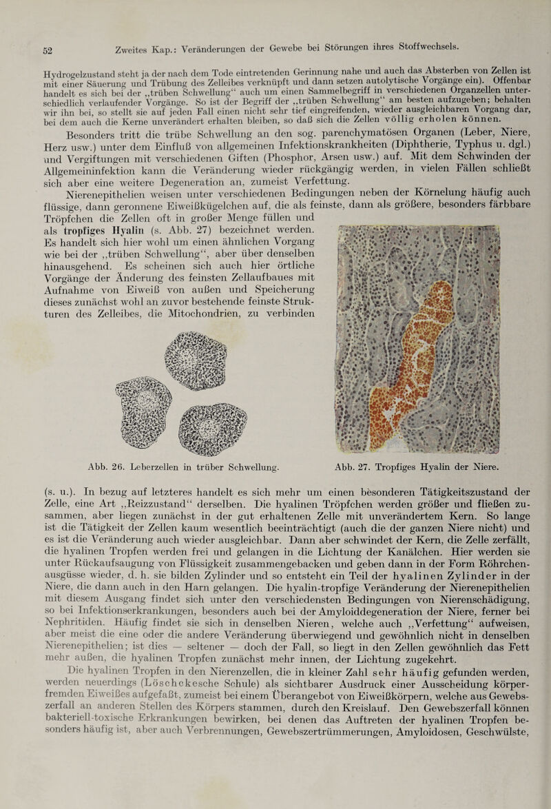Hydrogelzustand steht ja der nach dem Tode eintretenden Gerinnung nahe und auch das Absterben von Zellen ist mit einer Säuerung und Trübung des Zelleibes verknüpft und dann setzen autolytische Vorgänge ein). Offenbar handelt es sich bei der „trüben Schwellung“ auch um einen Sammelbegriff in verschiedenen Organzellen unter¬ schiedlich verlaufender Vorgänge. So ist der Begriff der „trüben Schwellung am besten aufzugeben; behalten wir ihn bei, so stellt sie auf jeden Fall einen nicht sehr tief eingreifenden, wieder ausgleichbaren Vorgang dar, bei dem auch die Kerne unverändert erhalten bleiben, so daß sich die Zellen völlig erholen können. Besonders tritt die trübe Schwellung an den sog. parenchymatösen Organen (Leber, Niere, Herz usw.) unter dem Einfluß von allgemeinen Infektionskrankheiten (Diphtherie, Typhus u. dgl.) und Vergiftungen mit verschiedenen Giften (Phosphor, Arsen usw.) auf. Mit dem Schwinden der Allgemeininfektion kann die Veränderung wieder rückgängig werden, in vielen Fällen schließt sich aber eine weitere Degeneration an, zumeist Verfettung. Nierenepithelien weisen unter verschiedenen Bedingungen neben der Körnelung häufig auch flüssige, dann geronnene Eiweißkügelchen auf, die als feinste, dann als größere, besonders färbbare Tröpfchen die Zellen oft in großer Menge füllen und als tropfiges Hyalin (s. Abb. 27) bezeichnet werden. Es handelt sich hier wohl um einen ähnlichen Vorgang wie bei der „trüben Schwellung“, aber über denselben hinausgehend. Es scheinen sich auch hier örtliche Vorgänge der Änderung des feinsten Zellaufbaues mit Aufnahme von Eiweiß von außen und Speicherung dieses zunächst wohl an zuvor bestehende feinste Struk¬ turen des Zelleibes, die Mitochondrien, zu verbinden CS*: %£***#» * 6 r T\* V2 Abb. 26. Leberzellen in trüber Schwellung. Abb. 27. Tropfiges Hyalin der Niere. (s. u.). In bezug auf letzteres handelt es sich mehr um einen besonderen Tätigkeitszustand der Zelle, eine Art „Reizzustand“ derselben. Die hyalinen Tröpfchen werden größer und fließen zu¬ sammen, aber liegen zunächst in der gut erhaltenen Zelle mit unverändertem Kern. So lange ist die Tätigkeit der Zellen kaum wesentlich beeinträchtigt (auch die der ganzen Niere nicht) und es ist die Veränderung auch wieder ausgleichbar. Dann aber schwindet der Kern, die Zelle zerfällt, die hyalinen Tropfen werden frei und gelangen in die Lichtung der Kanälchen. Hier werden sie unter Rückaufsaugung von Flüssigkeit zusammengebacken und geben dann in der Form Röhrchen¬ ausgüsse wieder, d. h. sie bilden Zylinder und so entsteht ein Teil der hyalinen Zylinder in der Niere, die dann auch in den Harn gelangen. Die hyalin-tropfige Veränderung der Nierenepithelien mit diesem Ausgang findet sich unter den verschiedensten Bedingungen von Nierenschädigung, so bei Infektionserkrankungen, besonders auch bei der Amyloiddegeneration der Niere, ferner bei Nephritiden. Häufig findet sie sich in denselben Nieren, welche auch „Verfettung“ aufweisen, aber meist die eine oder die andere Veränderung überwiegend und gewöhnlich nicht in denselben Nierenepithelien; ist dies — seltener — doch der Fall, so liegt in den Zellen gewöhnlich das Fett mehr außen, die hyalinen Tropfen zunächst mehr innen, der Lichtung zugekehrt. Die hyalinen Tropfen in den Nierenzellen, die in kleiner Zahl sehr häufig gefunden werden, werden neuerdings (Löschckesche Schule) als sichtbarer Ausdruck einer Ausscheidung körper¬ fremden Eiweißes aufgefaßt, zumeist bei einem Überangebot von Eiweißkörpern, welche aus Gewebs¬ zerfall an anderen Stellen des Körpers stammen, durch den Kreislauf. Den Gewebszerfall können bakteriell-toxische Fu’krankungen bewirken, bei denen das Auftreten der hyalinen Tropfen be¬ sonders häufig ist, aber auch Verbrennungen, Gewebszertrümmerungen, Amyloidosen, Geschwülste,