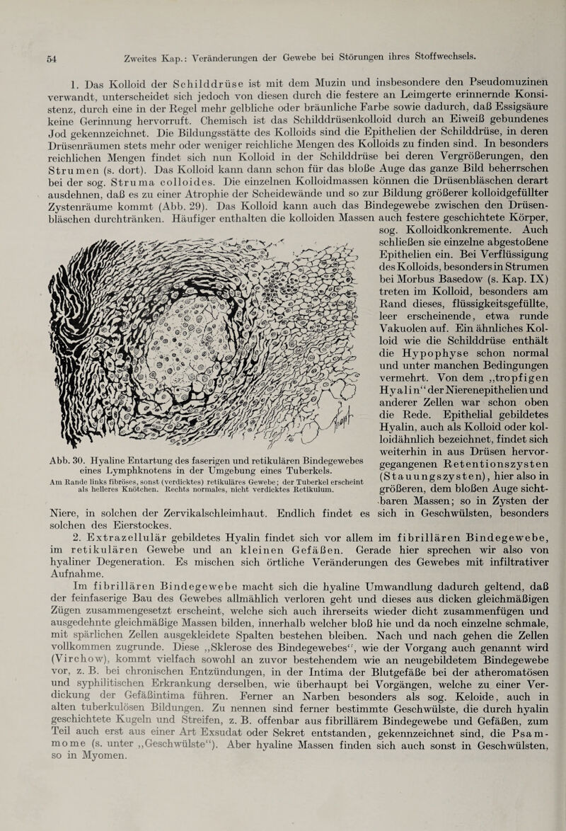 1. Das Kolloid der Schilddrüse ist mit dem Muzin und insbesondere den Pseudomuzinen verwandt, unterscheidet sich jedoch von diesen durch die festere an Leimgerte erinnernde Konsi¬ stenz, durch eine in der Pegel mehr gelbliche oder bräunliche Farbe sowie dadurch, daß Essigsäure keine5 Gerinnung hervorruft. Chemisch ist das Schilddrüsenkolloid durch an Eiweiß gebundenes Jod gekennzeichnet. Die Bildungsstätte des Kolloids sind die Epithelien der Schilddrüse, in deren Drüsenräumen stets mehr oder weniger reichliche Mengen des Kolloids zu finden sind. In besonders reichlichen Mengen findet sich nun Kolloid in der Schilddrüse bei deren Vergrößerungen, den Strumen (s. dort). Das Kolloid kann dann schon für das bloße Auge das ganze Bild beherrschen bei der sog. Struma colloides. Die einzelnen Kolloidmassen können die Drüsenbläschen derart ausdehnen, daß es zu einer Atrophie der Scheidewände und so zur Bildung größerer kolloidgefüllter Zystenräume kommt (Abb. 29). Das Kolloid kann auch das Bindegewebe zwischen den Drüsen¬ bläschen durchtränken. Häufiger enthalten die kolloiden Massen auch festere geschichtete Körper, sog. Kolloidkonkremente. Auch schließen sie einzelne abgestoßene Epithelien ein. Bei Verflüssigung des Kolloids, besonders in Strumen bei Morbus Basedow (s. Kap. IX) treten im Kolloid, besonders am Rand dieses, flüssigkeitsgefüllte, leer erscheinende, etwa runde Vakuolen auf. Ein ähnliches Kol¬ loid wie die Schilddrüse enthält die Hypophyse schon normal und unter manchen Bedingungen vermehrt. Von dem ,,tropfigen Hyalin“ der N ierenepithelien und anderer Zellen war schon oben die Rede. Epithelial gebildetes Hyalin, auch als Kolloid oder kol¬ loidähnlich bezeichnet, findet sich weiterhin in aus Drüsen hervor- gegangenen Retentionszysten (Stauungszysten), hier also in größeren, dem bloßen Auge sicht¬ baren Massen; so in Zysten der Niere, in solchen der Zervikalschleimhaut. Endlich findet es sich in Geschwülsten, besonders solchen des Eierstockes. 2. Extrazellulär gebildetes Hyalin findet sich vor allem im fibrillären Bindegewebe, im retikulären Gewebe und an kleinen Gefäßen. Gerade hier sprechen wir also von hyaliner Degeneration. Es mischen sich örtliche Veränderungen des Gewebes mit infiltrativer Aufnahme. Im fibrillären Bindegewebe macht sich die hyaline Umwandlung dadurch geltend, daß der feinfaserige Bau des Gewebes allmählich verloren geht und dieses aus dicken gleichmäßigen Zügen zusammengesetzt erscheint, welche sich auch ihrerseits wieder dicht zusammenfügen und ausgedehnte gleichmäßige Massen bilden, innerhalb welcher bloß hie und da noch einzelne schmale, mit spärlichen Zellen ausgekleidete Spalten bestehen bleiben. Nach und nach gehen die Zellen vollkommen zugrunde. Diese ,,Sklerose des Bindegewebes*', wie der Vorgang auch genannt wird (\ irchow), kommt vielfach sowohl an zuvor bestehendem wie an neugebildetem Bindegewebe vor, z. B. bei chronischen Entzündungen, in der Intima der Blutgefäße bei der atheromatösen und syphilitischen Erkrankung derselben, wie überhaupt bei Vorgängen, welche zu einer Ver¬ dickung der Gefäßintima führen. Ferner an Narben besonders als sog. Keloide, auch in alten tuberkulösen Bildungen. Zu nennen sind ferner bestimmte Geschwülste, die durch hyalin geschichtete Kugeln und Streifen, z. B. offenbar aus fibrillärem Bindegewebe und Gefäßen, zum Teil auch erst aus einer Art Exsudat oder Sekret entstanden, gekennzeichnet sind, die Psam¬ mome (s. unter ,,Geschwülste“). Aber hyaline Massen finden sich auch sonst in Geschwülsten, so in Myomen. Abb. 30. Hyaline Entartung des faserigen und retikulären Bindegewebes eines Lymphknotens in der Umgebung eines Tuberkels. Am Rande links fibröses, sonst (verdicktes) retikuläres Gewebe; der Tuberkel erscheint als helleres Knötchen. Rechts normales, nicht verdicktes Retikulum.