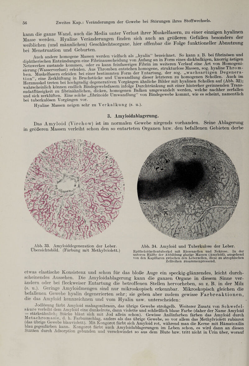 kann die ganze Wand, auch die Media unter Verlust ihrer Muskelfasern, zu einer einzigen hyalinen Masse werden. Hyaline Veränderungen finden sich auch an größeren Gefäßen besonders der weiblichen (und männlichen) Geschlechtsorgane, hier offenbar die Folge funktioneller Abnutzung bei Menstruation und Geburten. Auch andere homogene Massen werden vielfach als ,,hyalin bezeichnet. So kann z. B. bei fibrinösen und diphtherischen Entzündungen eine Fibrinausscheidung von Anfang an in Form eines dickbalkigen, knorrig ästigen Netzwerkes zustande kommen, oder es kann feinfaseriges Fibrin im weiteren \ erlauf eine Art von Homogeni¬ sierung (Wasser Verlust) erleiden. Aus Thromben entstehen homogene, strukturlose Massen, sog. hyaline Ihrom- ben Muskelfasern erleiden bei einer bestimmten Form der Entartung, der sog. „wachsartigen Degenera¬ tion“, eine Zerklüftung in Bruchstücke und Umwandlung dieser letzteren zu homogenen Schollen. Auch im Herzmuskel treten bei hochgradig degenerativen Vorgängen ähnliche Bilder mit hyalinen Schollen auf (Abb. 32); wahrscheinlich können endlich Bindegewebsfasern infolge Durchtränkung mit einer hinterher gerinnenden Trans¬ sudatflüssigkeit zu fibrinälmlichen, dicken, homogenen Balken umgewandelt werden, welche nachher zerfallen und sich zerklüften. Eine solche „fibrinoide Umwandlung“ von Bindegewebe kommt, wie es scheint, namentlich bei tuberkulösen Vorgängen vor. Hyaline Massen neigen sehr zu Verkalkung (s. u.). 3. Amyloidablagerung. Das Amyloid (Virchow) ist im normalen Gewebe nirgends vorhanden. Seine Ablagerung in größeren Massen verleiht schon den so entarteten Organen bzw. den befallenen Gebieten derbe Abb. 33. Amyloiddegeneration der Leber. Übersichtsbild. (Färbung mit Methylviolett.) Abb. 34. Amyloid und Tuberkulose der Leber. Epitheloidzellentuberkel mit lliesenzellen und Nekrose. In der unteren Hälfte der Abbildung glasige Massen (Amyloid), ausgehend von den Kapillaren zwischen den Leberzellen, diese zu atrophischen Zellreihen zusammenpressend. etwas elastische Konsistenz und schon für das bloße Auge ein speckig-glänzendes, leicht durch¬ scheinendes Aussehen. Die Amyloidablagerung kann die ganzen Organe in diesem Sinne ver¬ ändern oder bei fleckweiser Entartung die betroffenen Stellen hervorheben, so z. B. in der Milz (s. u.). Geringe Amyloidmengen sind nur mikroskopisch erkennbar. Mikroskopisch gleichen die befallenen Gewebe hyalin degenerierten sehr; sie geben aber zudem gewisse Farbreaktionen, die das Amyloid kennzeichnen und vom Hyalin usw. unterscheiden: Jodlösung färbt Amyloid mahagonibraun, das übrige Gewebe strohgelb. Weiterer Zusatz von Schwefel¬ säure verleiht dem Amyloid eine dunkelrote, dann violette und schließlich blaue Farbe (daher der Name Amyloid == stärkeähnlich; Stärke bläut sich mit Jod allein schon). Gewisse Anilinfarben färben das Amyloid durch Metachromasie, d. h. Iarbumschlag, anders als das übrige Gewebe, so vor allem das Methylviolett rubinrot (das übrige Gewebe blauviolett). Mit Kongorot färbt sich Amyloid rot, während man die Kerne mit Hämatoxilin r, au Segenfärben kann. Kongorot färbt auch Amyloidablagerungen im Leben schon, es wird dann an diesen Stätten durch Adsorption gebunden und verschwindet so aus dem Blute bzw. tritt nicht in Urin über, worauf