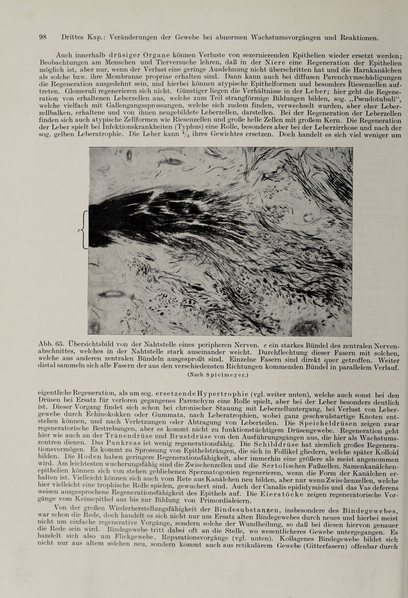 Auch innerhalb drüsiger Organe können Verluste von sezernierenden Epithelien wieder ersetzt werden; Beobachtungen am Menschen und Tierversuche lehren, daß in der Niere eine Regeneration der Epithelien möglich ist, aber nur, wenn der Verlust eine geringe Ausdehnung nicht überschritten hat und die Harnkanälchen als solche bzw. ihre Membranae propriae erhalten sind. Dann kann auch bei diffusen Parenchymschädigungen die Regeneration ausgedehnt sein, und hierbei können atypische Epithelformen und besonders Riesenzellen auf- treten. Glomeruli regenerieren sich nicht. Günstiger liegen die Verhältnisse in der Leber; hier geht die Regene¬ ration von erhaltenen Leberzellen aus, welche zum Teil strangförmige Bildungen bilden, sog. ,,Pseudotubuli“, welche vielfach mit Gallengangssprossungen, welche sich zudem finden, verwechselt wurden, aber eher Leber¬ zellbalken, erhaltene und von ihnen neugebildete Leberzellen, darstellen. Bei der Regeneration der Leberzellen finden sich auch atypische Zellformen wie Riesenzellen und große helle Zellen mit großem Kern. Die Regeneration der Leber spielt bei Infektionskrankheiten (Typhus) eine Rolle, besonders aber bei der Leberzirrhose und nach der sog. gelben Leberatrophie. Die Leber kann 4/5 ihres Gewichtes ersetzen. Doch handelt es sich viel weniger um Abb. 65. Übersichtsbild von der Nahtstelle eines peripheren Nerven, c ein starkes Bündel des zentralen Nerven¬ abschnittes, welches in der Nahtstelle stark auseinander weicht. Durchflechtung dieser Fasern mit solchen, welche aus anderen zentralen Bündeln ausgesproßt sind. Einzelne Fasern sind direkt quer getroffen. Weiter distal sammeln sich alle Fasern der aus den verschiedensten Richtungen kommenden Bündel in parallelem Verlauf. (Nach Spielmeyer.) eigentliche Regeneration, als um sog. ersetzendeHypertrophie (vgl. weiter unten), welche auch sonst bei den Drüsen bei Ersatz für verloren gegangenes Parenchym eine Rolle spielt, aber bei der Leber besonders deutlich ist. Dieser Vorgang findet sich schon bei chronischer Stauung mit Leberzelluntergang, bei Verlust von Leber¬ gewebe durch Echinokokken oder Gummata, nach Leberatrophien, wobei ganz geschwulstartige Knoten ent¬ stehen können, und nach Verletzungen oder Abtragung von Leberteilen. Die Speicheldrüsen zeigen zwar regeneratorische Bestrebungen, aber es kommt nicht zu funktionstüchtigem Drüsengewebe. Regeneration geht hier wie auch an der Tränendrüse und Brustdrüse von den Ausführungsgängen aus, die hier als Wachstums¬ zentren dienen. Das Pankreas ist wenig regenerationsfähig. Die Schilddrüse hat ziemlich großes Regenera¬ tionsvermögen. Es kommt zu Sprossung von Epithelsträngen, die sich in Follikel gliedern, welche später Kolloid nlden. Die Hoden haben geringere Regenerationsfähigkeit, aber immerhin eine größere als meist angenommen wmd. Am leichtesten wucherungsfähig sind die Zwischenzellen und die Ser tolisehen Fußzellen. Samenkanälchen- epithelien können sich von stehen gebliebenen Spermatogonien regenerieren, wenn die Form der Kanälchen er- ia en ist. Vielleicht können sich auch vom Rete aus Kanälchen neu bilden, aber nur wenn Zwischenzellen, welche hier vielleicht eine troplnsche Rolle spielen, gewuchert sind. Auch der Canalis epididymidis und das Vas deferens weisen ausgesprochene Legenerationsfähigkeit des Epithels auf. Die Eierstöcke zeigen regeneratorische Vor¬ gänge vom Keimepithel aus bis zur Bildung von Primordialeiern. Von der großen Wiederherstellungsfähigkeit der Bindesubstanzen, insbesondere des Bindegewebes, war schon die Rede, doch handelt es sich nicht nur um Ersatz alten Bindegewebes durch neues und hierbei meist nicht um einfache regenerative Vorgänge, sondern solche der Wundheilung, so daß bei diesen hiervon genauer i U i u6 ^eJn 'Vlf aodegevebe tritt dabei oft an die Stelle, wo wesentlicheres Gewebe untergegangen. Es handelt sich also um Mickgewebe, Reparationsvorgänge (vgl. unten). Koilagenes Bindegewebe bildet sich mclit nur aus altem solchen neu, sondern kommt auch aus retikulärem Gewebe (Gitterfasern) offenbar durch