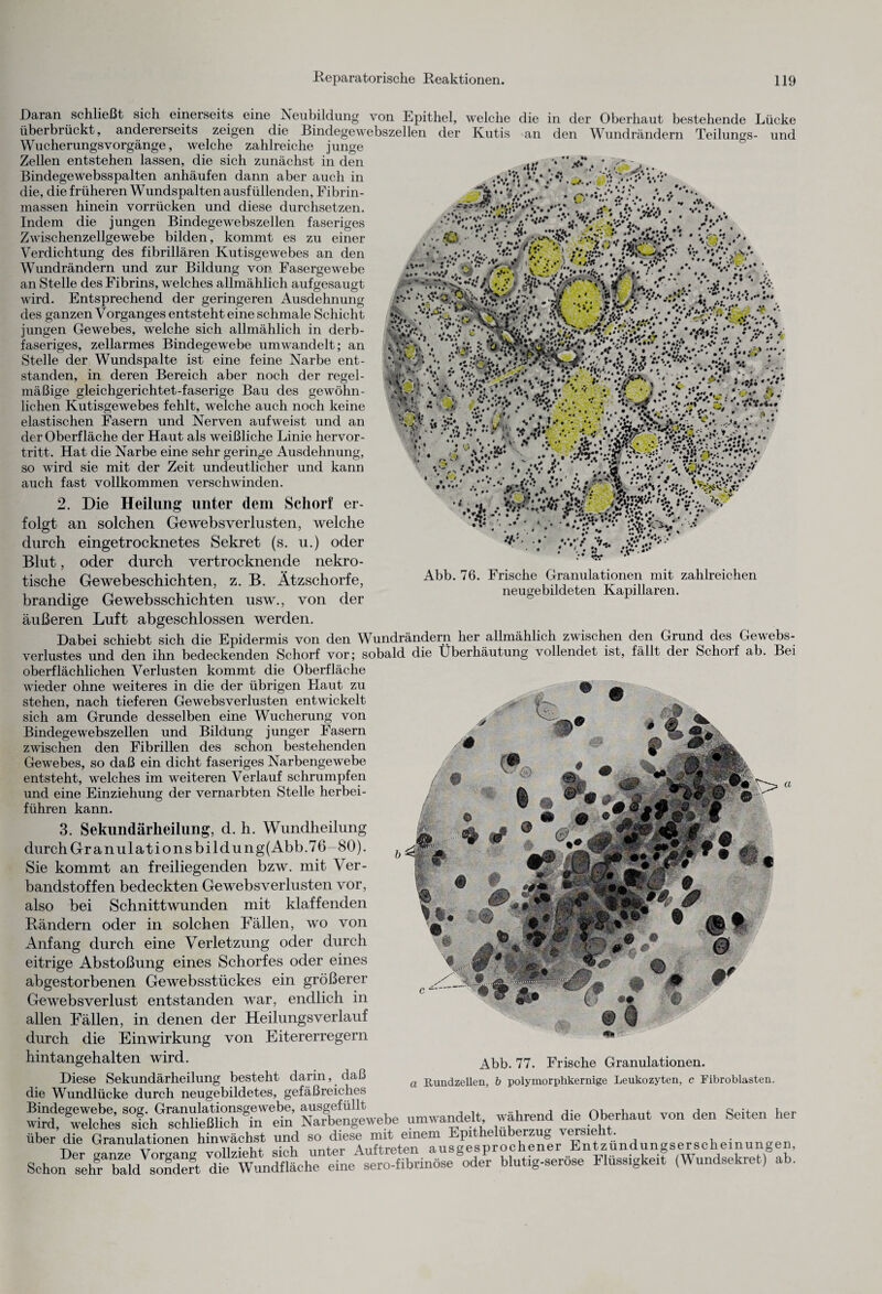 Abb. 76. Frische Granulationen mit zahlreichen neugebildeten Kapillaren. Daran schließt sich einerseits eine Neubildung von Epithel, welche die in der Oberhaut bestehende Lücke überbrückt, andererseits zeigen die Bindegewebszellen der Kutis an den Wundrändern Teilungs- und Wucherungsvorgänge, welche zahlreiche junge Zellen entstehen lassen, die sich zunächst in den Bindegewebsspalten anhäufen dann aber auch in die, die früheren Wundspalten ausfüllenden, Fibrin¬ massen hinein vorrücken und diese durchsetzen. Indem die jungen Bindegewebszellen faseriges Zwischenzellgewebe bilden, kommt es zu einer Verdichtung des fibrillären Kutisgewebes an den Wundrändern und zur Bildung von Fasergewebe an Stelle des Fibrins, welches allmählich aufgesaugt wird. Entsprechend der geringeren Ausdehnung des ganzen Vorganges entsteht eine schmale Schicht jungen Gewebes, welche sich allmählich in derb¬ faseriges, zellarmes Bindegewebe umwandelt; an Stelle der Wundspalte ist eine feine Narbe ent¬ standen, in deren Bereich aber noch der regel¬ mäßige gleichgerichtet-faserige Bau des gewöhn¬ lichen Kutisgewebes fehlt, welche auch noch keine elastischen Fasern und Nerven aufweist und an der Oberfläche der Haut als weißliche Linie hervor¬ tritt. Hat die Narbe eine sehr geringe Ausdehnung, so wird sie mit der Zeit undeutlicher und kann auch fast vollkommen verschwinden. 2. Die Heilung unter dem Schorf er¬ folgt an solchen Gewebsverlusten, welche durch eingetrocknetes Sekret (s. u.) oder Blut, oder durch vertrocknende nekro¬ tische Gewebeschichten, z. B. Ätzschorfe, brandige Ge websschichten usw., von der äußeren Luft abgeschlossen werden. Dabei schiebt sich die Epidermis von den Wundrändern her allmählich zwischen den Grund des Gewebs- verlustes und den ihn bedeckenden Schorf vor; sobald die Überhäufung vollendet ist, fällt der Schorf ab. Bei oberflächlichen Verlusten kommt die Oberfläche wieder ohne weiteres in die der übrigen Flaut zu stehen, nach tieferen Gewebsverlusten entwickelt sich am Grunde desselben eine Wucherung von Bindegewebszellen und Bildung junger Fasern zwischen den Fibrillen des schon bestehenden Gewebes, so daß ein dicht faseriges Narbengewebe entsteht, welches im weiteren Verlauf schrumpfen und eine Einziehung der vernarbten Stelle herbei¬ führen kann. 3. Sekundärkeilung, d. h. Wundheilung durch Granulat io ns bildung(Abb.76 80). Sie kommt an freiliegenden bzw. mit Ver¬ bandstoffen bedeckten Gewebsverlusten vor, also bei Schnittwunden mit klaffenden Rändern oder in solchen Fällen, wo von Anfang durch eine Verletzung oder durch eitrige Abstoßung eines Schorfes oder eines abgestorbenen Gewebsstückes ein größerer Gewebsverlust entstanden war, endlich in allen Fällen, in denen der Heilungsverlauf durch die Einwirkung von Eitererregern hintangehalten wird. Diese Sekundärheilung besteht darin, daß die Wundlücke durch neugebildetes, gefäßreiches Narbengewebe umwandelt während die Oberhaut von den Seiten her über die Granulationen hmwachst und sc“TusgPespröchener Entzündungserscheinungen, Seho„DesrehgrabaldVs3:rgt “uUflLhV^se^ibrinöseblutig-seröse Flüssigkeit (Wundsekret) ab. Abb. 77. Frische Granulationen. a Rundzellen, b polymorphkernige Leukozyten, c Fibroblasten.