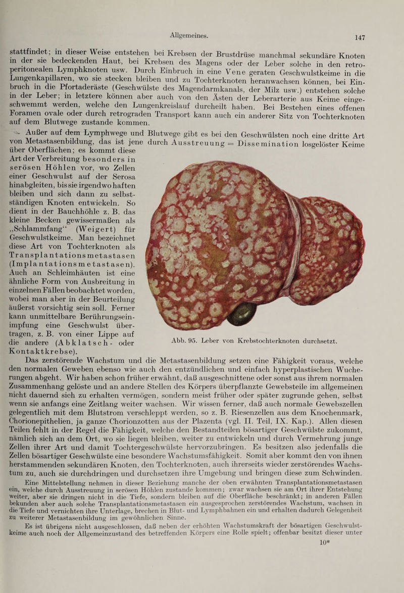 stattfindet; in dieser Weise entstehen bei Krebsen der Brustdrüse manchmal sekundäre Knoten m der sie bedeckenden Haut, bei Krebsen des Magens oder der Leber solche in den retro- pentonealen Lymphknoten usw. Durch Einbruch in eine Vene geraten Geschwulstkeime in die Lungenkapillaren, wo sie stecken bleiben und zu Tochterknoten heranwachsen können, bei Ein¬ bruch m die Pfortaderäste (Geschwülste des Magendarmkanals, der Milz usw.) entstehen solche in der Leber, in letztere können aber auch von den Ästen der Leberarterie aus Keime einge- schwemmt werden, welche den Lungenkreislauf durcheilt haben. Bei Bestehen eines offenen Foramen ovale oder durch retrograden Transport kann auch ein anderer Sitz von Tochterknoten auf dem Blutwege zustande kommen. - Außer auf dem Lymphwege und Blutwege gibt es bei den Geschwülsten noch eine dritte Art von Metastasenbildung, das ist jene durch Ausstreuung = Bissemination losgelöster Keime über Oberflächen; es kommt diese Art der Verbreitung besonders in serösen Höhlen vor, wo Zellen einer Geschwulst auf der Serosa hinabgleiten, bis sie irgendwo haften bleiben und sich dann zu selbst¬ ständigen Knoten entwickeln. So dient in der Bauchhöhle z. B. das kleine Becken gewissermaßen als ,, Schlammfang“ (Weigert) für Geschwulstkeime. Man bezeichnet diese Art von Tochterknoten als Transplantat io ns m et astasen (Implantat ionsmetastasen). Auch an Schleimhäuten ist eine ähnliche Form von Ausbreitung in einzelnen Fällen beobachtet worden, wobei man aber in der Beurteilung äußerst vorsichtig sein soll. Ferner kann unmittelbare Berührungsein¬ impfung eine Geschwulst über¬ tragen, z. B. von einer Lippe auf die andere (Abklatsch- oder Abb. 95. Leber von Krebstochterknoten durchsetzt. Kontakt krebse). Das zerstörende Wachstum und die Metastasenbildung setzen eine Fähigkeit voraus, welche den normalen Geweben ebenso wie auch den entzündlichen und einfach hyperplastischen Wuche¬ rungen abgeht. Wir haben schon früher erwähnt, daß ausgeschnittene oder sonst aus ihrem normalen Zusammenhang gelöste und an andere Stellen des Körpers überpflanzte Gewebsteile im allgemeinen nicht dauernd sich zu erhalten vermögen, sondern meist früher oder später zugrunde gehen, selbst wenn sie anfangs eine Zeitlang weiter wachsen. Wir wissen ferner, daß auch normale Gewebszellen gelegentlich mit dem Blutstrom verschleppt werden, so z. B. Kiesenzellen aus dem Knochenmark, Chorionepithelien, ja ganze Chorionzotten aus der Plazenta (vgl. II. Teil, IX. Kap.). Allen diesen Teilen fehlt in der Regel die Fähigkeit, welche den Bestandteilen bösartiger Geschwülste zukommt, nämlich sich an dem Ort, wo sie liegen bleiben, weiter zu entwickeln und durch Vermehrung junge Zellen ihrer Art und damit Tochtergeschwülste hervorzubringen. Es besitzen also jedenfalls die Zellen bösartiger Geschwülste eine besondere Wachstumsfähigkeit. Somit aber kommt den von ihnen herstammenden sekundären Knoten, den Tochterknoten, auch ihrerseits wieder zerstörendes Wachs¬ tum zu, auch sie durchdringen und durchsetzen ihre Umgebung und bringen diese zum Schwinden, Eine Mittelstellung nehmen in dieser Beziehung manche der oben erwähnten Transplantationsmetastasen ein, welche durch Ausstreuung in serösen Höhlen zustande kommen; zwar wachsen sie am Ort ihrer Entstehung weiter, aber sie dringen nicht in die Tiefe, sondern bleiben auf die Oberfläche beschränkt; in anderen Fällen bekunden aber auch solche Transplantationsmetastasen ein ausgesprochen zerstörendes Wachstum, wachsen in die Tiefe und vernichten ihre Unterlage, brechen in Blut- und Lymphbahnen ein und erhalten dadurch Gelegenheit zu weiterer Metastasenbildung im gewöhnlichen Sinne. Es ist übrigens nicht ausgeschlossen, daß neben der erhöhten Wachstumskraft der bösartigen Geschwulst¬ keime auch noch der Allgemeinzustand des betreffenden Körpers eine Rolle spielt; offenbar besitzt dieser unter 10*