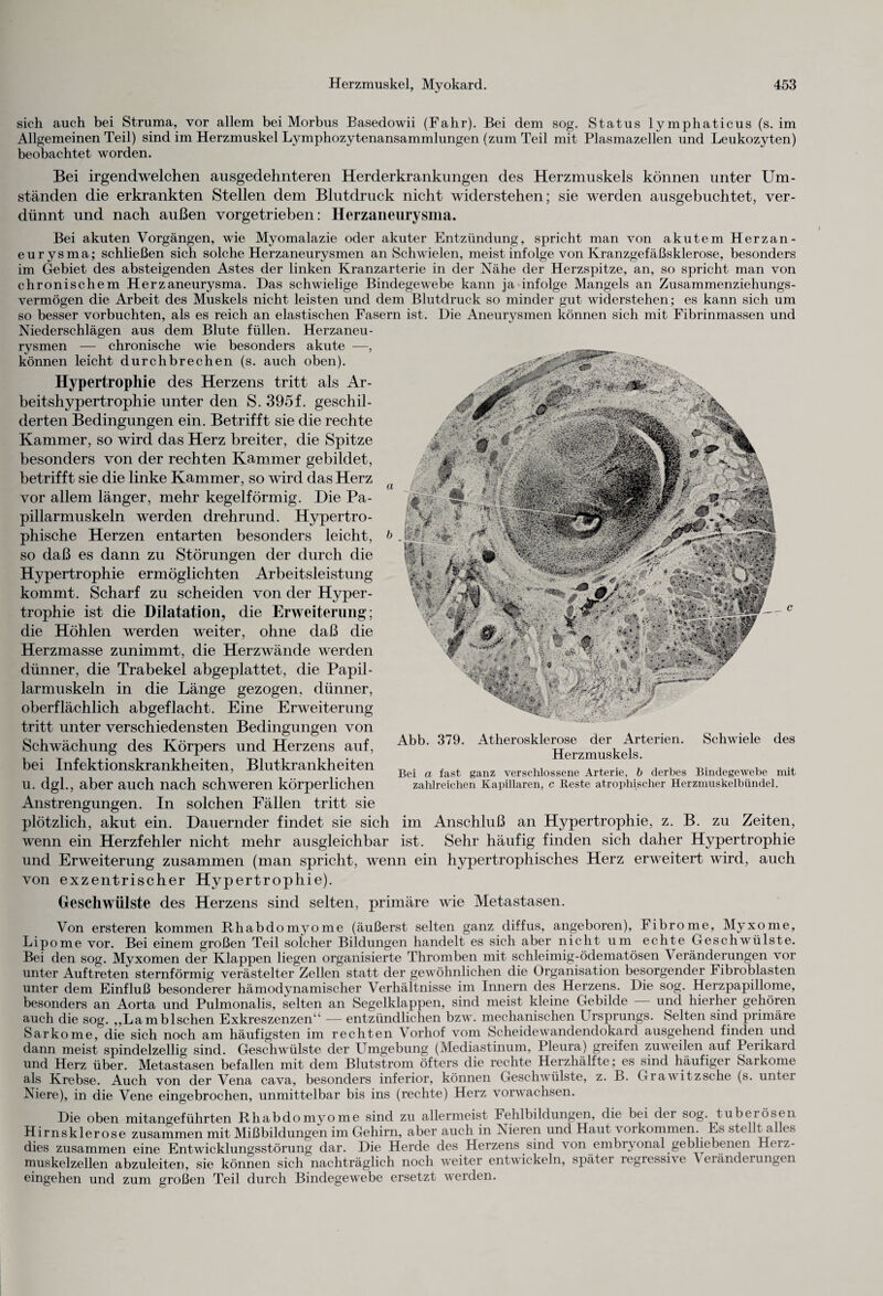 sich auch bei Struma, vor allem bei Morbus Basedowii (Fahr). Bei dem sog. Status lymphaticus (s. im Allgemeinen Teil) sind im Herzmuskel Lymphozytenansammlungen (zum Teil mit Plasmazellen und Leukozyten) beobachtet worden. Bei irgendwelchen ausgedehnteren Herderkrankungen des Herzmuskels können unter Um¬ ständen die erkrankten Stellen dem Blutdruck nicht widerstehen; sie werden ausgebuchtet, ver¬ dünnt und nach außen vorgetrieben: Herzaneurysma. Bei akuten Vorgängen, wie Myomalazie oder akuter Entzündung, spricht man von akutem Herzan¬ eurysma; schließen sich solche Herzaneurysmen an Schwielen, meist infolge von Kranzgefäßsklerose, besonders im Gebiet des absteigenden Astes der linken Kranzarterie in der Nähe der Herzspitze, an, so spricht man von chronischem Herzaneurysma. Das schwielige Bindegewebe kann ja infolge Mangels an Zusammenziehungs¬ vermögen die Arbeit des Muskels nicht leisten und dem Blutdruck so minder gut widerstehen; es kann sich um so besser vorbuchten, als es reich an elastischen Fasern ist. Die Aneurysmen können sich mit Fibrinmassen und Niederschlägen aus dem Blute füllen. Herzaneu¬ rysmen — chronische wie besonders akute —, können leicht durchbrechen (s. auch oben). Hypertrophie des Herzens tritt als Ar¬ beitshypertrophie unter den S. 395f. geschil¬ derten Bedingungen ein. Betrifft sie die rechte Kammer, so wird das Herz breiter, die Spitze besonders von der rechten Kammer gebildet, betrifft sie die linke Kammer, so wird das Herz vor allem länger, mehr kegelförmig. Hie Pa- pillarmuskeln werden drehrund. Hypertro¬ phische Herzen entarten besonders leicht, &. so daß es dann zu Störungen der durch die Hypertrophie ermöglichten Arbeitsleistung kommt. Scharf zu scheiden von der Hyper¬ trophie ist die Dilatation, die Erweiterung; die Höhlen werden weiter, ohne daß die Herzmasse zunimmt, die Herzwände werden dünner, die Trabekel abgeplattet, die Papil- larmuskeln in die Länge gezogen, dünner, oberflächlich abgeflacht. Eine Erweiterung tritt unter verschiedensten Bedingungen von Schwächung des Körpers und Herzens auf, Abb- 379' Atherosklerose^ der^Arterien. Schwiele des bei Infektionskrankheiten, Blutkrankheiten Be, o fast ganz ^^ZTZie, % detbes Bindegewebe mit U. dgl., aber auch nach schweren körperlichen zahlreichen Kapillaren, c Reste atrophischer Herzmuskelbundel. Anstrengungen. In solchen Fällen tritt sie plötzlich, akut ein. Dauernder findet sie sich im Anschluß an Hypertrophie, z. B. zu Zeiten, wenn ein Herzfehler nicht mehr ausgleichbar ist. Sehr häufig finden sich daher Hypertrophie und Erweiterung zusammen (man spricht, wenn ein hypertrophisches Herz erweitert wird, auch von exzentrischer Hypertrophie). Geschwülste des Herzens sind selten, primäre wie Metastasen. Von ersteren kommen Rhabdomyome (äußerst selten ganz diffus, angeboren), Fibrome, Myxome, Lipome vor. Bei einem großen Teil solcher Bildungen handelt es sich aber nicht um echte Geschwülste. Bei den sog. Myxomen der Klappen liegen organisierte Thromben mit schleimig-ödematösen Veränderungen vor unter Auftreten sternförmig verästelter Zellen statt der gewöhnlichen die Organisation besorgender I ibroblasten unter dem Einfluß besonderer hämodynamischer Verhältnisse im Innern des Herzens. Die sog. Herzpapillome, besonders an Aorta und Pulmonalis, selten an Segelklappen, sind meist kleine Gebilde und hierher gehören auch die sog. „Lamblschen Exkreszenzen“ — entzündlichen bzw. mechanischen Ursprungs. Selten sind primäre Sarkome, die sich noch am häufigsten im rechten Vorhof vom Scheidewandendokard ausgehend finden und dann meist spindelzellig sind. Geschwülste der Umgebung (Mediastinum, Pleura) greifen zuweilen auf Perikard und Herz über. Metastasen befallen mit dem Blutstrom öfters die rechte Herzhälfte; es sind häufiger Sarkome als Krebse. Auch von der Vena cava, besonders inferior, können Geschwülste, z. B. Grawitzsche (s. unter Niere), in die Vene eingebrochen, unmittelbar bis ins (rechte) Herz vorwachsen. Die oben mitangeführten Rhabdomyome sind zu allermeist Fehlbildungen, die bei dei sog. tu bei Ösen Hirnsklerose zusammen mit Mißbildungen im Gehirn, aber auch in Nieren und Haut voikommen. Es stelltalles dies zusammen eine Entwicklungsstörung dar. Die Herde des Herzens sind von embryonal gebliebenen Heiz- muskelzellen abzuleiten, sie können sich nachträglich noch weiter entwickeln, spätei regressive Veränderungen eingehen und zum großen Teil durch Bindegewebe ersetzt werden.