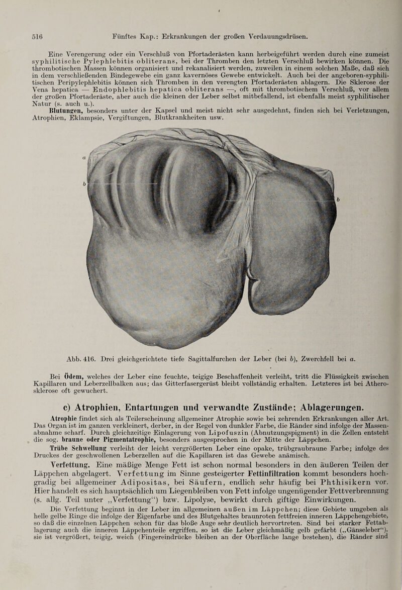 Eine Verengerung oder ein Verschluß von Pfortaderästen kann herbeigeführt werden durch eine zumeist syphilitische Pylephlebitis obliterans, bei der Thromben den letzten Verschluß bewirken können. Die thrombotischen Massen können organisiert und rekanalisiert werden, zuweilen in einem solchen Maße, daß sich in dem verschließenden Bindegewebe ein ganz kavernöses Gewebe entwickelt. Auch bei der angeboren-syphili¬ tischen Peripylephlebitis können sich Thromben in den verengten Pfortaderästen ablagern. Die Sklerose der Vena hepatica — Endophlebitis hepatica obliterans —, oft mit thrombotischem Verschluß, vor allem der großen Pfortaderäste, aber auch die kleinen der Leber selbst mitbefallend, ist ebenfalls meist syphilitischer Natur (s. auch u.). Blutungen, besonders unter der Kapsel und meist nicht sehr ausgedehnt, finden sich bei Verletzungen, Atrophien, Eklampsie, Vergiftungen, Blutkrankheiten usw. Abb. 416. Drei gleichgerichtete tiefe Sagittalfurchen der Leber (bei b), Zwerchfell bei a. Bei Ödem, welches der Leber eine feuchte, teigige Beschaffenheit verleiht, tritt die Flüssigkeit zwischen Kapillaren und Leberzellbalken aus; das Gitterfasergerüst bleibt vollständig erhalten. Letzteres ist bei Athero¬ sklerose oft gewuchert. c) Atrophien, Entartungen und verwandte Zustände; Ablagerungen. Atrophie findet sich als Teilerscheinung allgemeiner Atrophie sowie bei zehrenden Erkrankungen aller Art. Das Organ ist im ganzen verkleinert, derber, in der Regel von dunkler Farbe, die Ränder sind infolge der Massen¬ abnahme scharf. Durch gleichzeitige Einlagerung von Lipofuszin (Abnutzungspigment) in die Zellen entsteht die sog. braune oder Pigmentatrophie, besonders ausgesprochen in der Mitte der Läppchen. Trübe Schwellung verleiht der leicht vergrößerten Leber eine opake, trübgraubraune Farbe; infolge des Druckes der geschwollenen Leberzellen auf die Kapillaren ist das Gewebe anämisch. Verfettung. Eine mäßige Menge Fett ist schon normal besonders in den äußeren Teilen der Läppchen abgelagert. Verfettung im Sinne gesteigerter Fettinfiltration kommt besonders hoch¬ gradig bei allgemeiner Adipositas, bei Säufern, endlich sehr häufig bei Phthisikern vor. Hier handelt es sich hauptsächlich um Liegenbleiben von Fett infolge ungenügender Fett Verbrennung (s. allg. Teil unter „Verfettung“) bzw. Lipolyse, bewirkt durch giftige Einwirkungen. Die Verfettung beginnt in der Leber im allgemeinen außen im Läppchen; diese Gebiete umgeben als helle gelbe Ringe die infolge der Eigenfarbe und des Blutgehaltes braunroten fettfreien inneren Läppchengebiete, so daß die einzelnen Läppchen schon für das bloße Auge sehr deutlich hervortreten. Sind bei starker Fettab¬ lagerung auch die inneren Läppchenteile ergriffen, so ist die Leber gleichmäßig gelb gefärbt („Gänseleber“), sie ist vergrößert, teigig, weich (Fingereindrücke bleiben an der Oberfläche lange bestehen), die Ränder sind