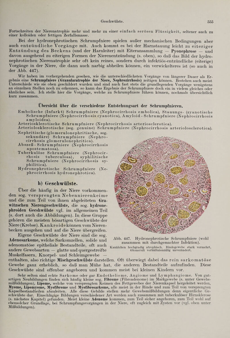 Portschreiten der Nierenatrophie mehr und mehr zu einer einfach serösen Flüssigkeit, seltener auch zu einer kolloiden oder fettigen Zerfallsmasse. Bei der hydronephrotischen Schrumpfniere spielen außer mechanischen Bedingungen aber auch entzündliche Vorgänge mit. Auch kommt es bei der Harnstauung leicht zu eiteriger Entzündung des Beckens (und der Harnleiter) mit Eiteransammlung — Pyonephrose — und davon ausgehend zu eiterigen Formen der Nierenentzündung (s. oben), so daß das Bild der hydro¬ nephrotischen Nierenatrophie sehr oft kein reines, sondern durch infektiös-entzündliche (eiterige) Vorgänge in der Niere, die dann auch narbig abheilen können, ein verwickelteres ist (so auch in der Abb. 447). Wir haben im vorhergehenden gesehen, wie die unterschiedlichsten Vorgänge von längerer Dauer als Er¬ gebnis eine Schrumpfniere (Granularatrophie der Niere, Nephrozirrhosis) zeitigen können. Bestehen auch meist Unterschiede wie sie oben geschildert wurden und sind auch fast stets die grundlegenden Vorgänge wenigstens an einzelnen Stellen noch zu erkennen, so kann das Ergebnis der Schrumpfniere doch ein in vielem gleiches oder ähnliches sein. Ich stelle hier die Vorgänge, welche zu Schrumpfniere führen können, nochmals übersichtlich kurz zusammen. Übersicht über die verschiedene Entstehungsart der Schrumpfnieren, Embolische (Infarkt) Schrumpfniere (Nephrocirrhosis embolica), Stauungs- (zyanotische Schrumpfniere (Nephrocirrhosis cyanotica), Amyloid - Schrumpf niere (Nephrocirrhosis amyloidea). Arteriosklerotische Schrumpf niere (Nephrocirrhosis arteriosclerotica). Arteriolosklerotische (sog. genuine) Schrumpfniere (Nephrocirrhosis arteriolosclerotica). Nephritische (glomerulonephritische, sog. sekundäre) Schrumpfniere (Nephro¬ cirrhosis glo merulonephritica). Abszeß - Schrumpf niere (Nephrocirrhosis apostematosa). Tuberkulöse Schrumpfniere (Nephrocir¬ rhosis tuberculosa), syphilitische Schrumpfniere (Nephrocirrhosis sy¬ philitica). Hydronephrotische Schru mpfniere (Ne¬ phrocirrhosis hydronephrotica). li) Geschwülste. Über die häufig in der Niere vorkommen¬ den sog. versprengten Nebennierenkeime und die zum Teil von ihnen abgeleiteten Gra- witzschen Nierengeschwülste, die sog. hydrone- phroiden Gecshwülste vgl. im allgemeinen Teil (s. dort auch die Abbildungen). In diese Gruppe gehören die meisten bösartigen Geschwülste der Niere (Krebse). Kankroidekönnen vom Nieren¬ becken ausgehen und auf die Niere übergreifen. Eigene Geschwülste der Niere sind die sog. Adenosarkome, welche Sarkomzellen, solide und adenomatöse epitheliale Bestandteile, oft auch andere Ge websarten — glatte und quergestreifte Muskelfasern, Knorpel- und Schleimgewebe — enthalten, also richtige Mischgeschwülste darstellen. Oft überwiegt dabei das rein sarkomatöse Gewebe ganz erheblich, so daß man Mühe hat, die anderen Bestandteile aufzufinden. Diese Geschwülste sind offenbar angeboren und kommen meist bei kleinen Kindern vor. Abb. 447. Hydronephrotische Schrumpf niere (wohl zusammen mit durchgemachter Infektion). Kanälchen hochgradig atrophisch. Bindegewebe stark vermehrt, Glomeruli verhältnismäßig unverändert. Sehr selten sind echte Sarkome oder gar Endotheliome, Angiome und Lymphangiome. Von gut¬ artigen Neubildungen finden sich häufig kleine sog. Fibrome (Fibroadenome) im Markgewebe (s. unter Gewebs¬ mißbildungen), Lipome, welche von versprengten Keimen des Fettgewebes der Nierenkapsel hergeleitet werden, Myome, Lipomyome, Myofibrome und Myofibrosarkome, alle meist in der Rinde und zum Teil von versprengten Kapselbestandteilen abzuleiten. Alle diese Gebilde stellen mehr Gewebsmißbildungen denn eigentliche Ge¬ schwülste dar. Einschlägige Bildungen verschiedener Art werden auch zusammen mit tuberkulöser Hirnsklerose (s. nächstes Kapitel) gefunden. Meist kleine Adenome kommen, zum Teil sicher angeboren, zum Teil wohl auf ebensolcher Grundlage, bei Schrumpfungsvorgängen in der Niere, oft zugleich mit Zysten vor (vgl. oben unter Mißbildungen).