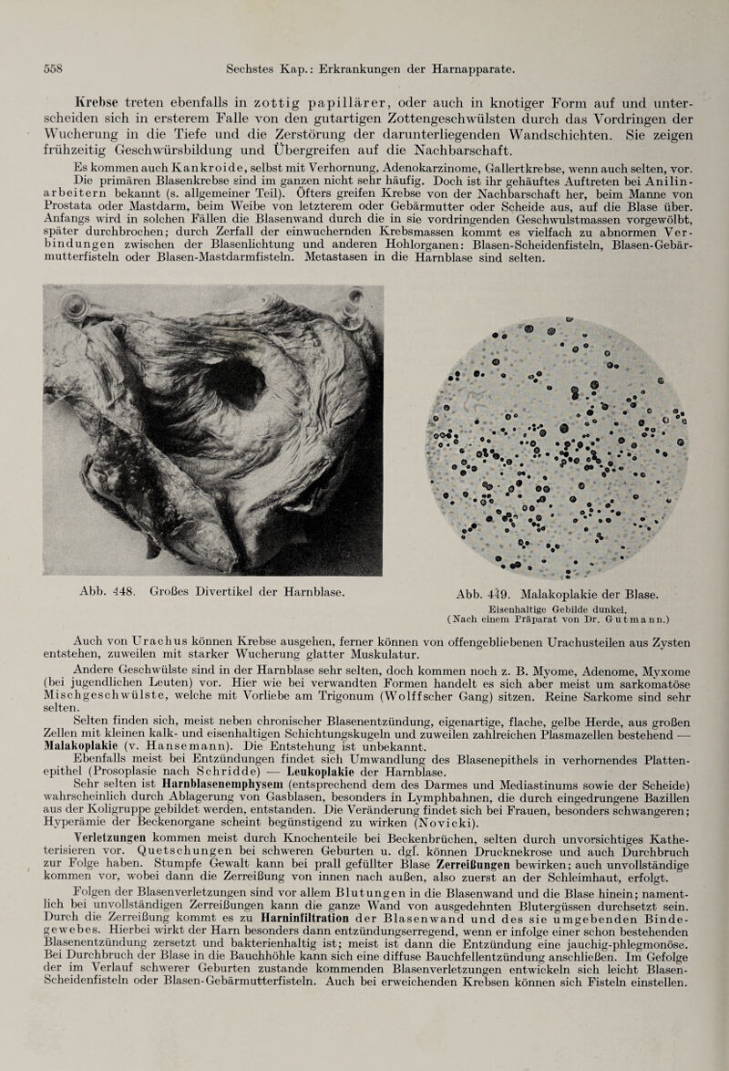 Krebse treten ebenfalls in zottig papillärer, oder auch in knotiger Form auf und unter¬ scheiden sich in ersterem Falle von den gutartigen Zottengeschwülsten durch das Vordringen der Wucherung in die Tiefe und die Zerstörung der darunterliegenden Wandschichten. Sie zeigen frühzeitig Geschwürsbildung und Übergreifen auf die Nachbarschaft. Es kommen auch Kankroide, selbst mit Verhornung, Adenokarzinome, Gallertkrebse, wenn auch selten, vor. Die primären Blasenkrebse sind im ganzen nicht sehr häufig. Doch ist ihr gehäuftes Auftreten bei Anilin - arbeitern bekannt (s. allgemeiner Teil). Öfters greifen Krebse von der Nachbarschaft her, beim Manne von Prostata oder Mastdarm, beim Weibe von letzterem oder Gebärmutter oder Scheide aus, auf die Blase über. Anfangs wird in solchen Fällen die Blasenwand durch die in sie vordringenden Geschwulstmassen vorgewölbt, später durchbrochen; durch Zerfall der einwuchernden Krebsmassen kommt es vielfach zu abnormen Ver¬ bindungen zwischen der Blasenlichtung und anderen Hohlorganen: Blasen-Scheidenfisteln, Blasen-Gebär¬ mutterfisteln oder Blasen-Mastdarmfisteln. Metastasen in die Harnblase sind selten. Abb. 448. Großes Divertikel der Harnblase. Abb. 449. Malakoplakie der Blase. Eisenhaltige Gebilde dunkel. (Nach einem Präparat von Dr. Gutmann.) Auch von Urachus können Krebse ausgehen, ferner können von offengebliebenen Urachusteilen aus Zysten entstehen, zuweilen mit starker Wucherung glatter Muskulatur. Andere Geschwülste sind in der Harnblase sehr selten, doch kommen noch z. B. Myome, Adenome, Myxome (bei jugendlichen Leuten) vor. Hier wie bei verwandten Formen handelt es sich aber meist um sarkomatöse Mischgeschwülste, welche mit Vorliebe am Trigonum (Wolffscher Gang) sitzen. Reine Sarkome sind sehr selten. Selten finden sich, meist neben chronischer Blasenentzündung, eigenartige, flache, gelbe Herde, aus großen Zellen mit kleinen kalk- und eisenhaltigen Schichtungskugeln und zuweilen zahlreichen Plasmazellen bestehend -—- Malakoplakie (v. Hanse mann). Die Entstehung ist unbekannt. Ebenfalls meist bei Entzündungen findet sich Umwandlung des Blasenepithels in verhornendes Platten¬ epithel (Prosoplasie nach Schridde) — Leukoplakie der Harnblase. Sehr selten ist Harnblasenemphysem (entsprechend dem des Darmes und Mediastinums sowie der Scheide) wahrscheinlich durch Ablagerung von Gasblasen, besonders in Lymphbahnen, die durch eingedrungene Bazillen aus der Koligruppe gebildet werden, entstanden. Die Veränderung findet sich bei Frauen, besonders schwangeren; Hyperämie der Beckenorgane scheint begünstigend zu wirken (Novicki). Verletzungen kommen meist durch Knochenteile bei Beckenbrüchen, selten durch unvorsichtiges Kathe- terisieren vor. Quetschungen bei schweren Geburten u. dgl. können Drucknekrose und auch Durchbruch zur Folge haben. Stumpfe Gewalt kann bei prall gefüllter Blase Zerreißungen bewirken; auch unvollständige kommen vor, wobei dann die Zerreißung von innen nach außen, also zuerst an der Schleimhaut, erfolgt. Folgen der Blasenverletzungen sind vor allem Blutungen in die Blasenwand und die Blase hinein; nament¬ lich bei unvollständigen Zerreißungen kann die ganze Wand von ausgedehnten Blutergüssen durchsetzt sein. Durch die Zerreißung kommt es zu Harninfiltration der Blasenwand und des sie umgebenden Binde¬ gewebes. Hierbei wirkt der Harn besonders dann entzündungserregend, wenn er infolge einer schon bestehenden Blasenentzündung zersetzt und bakterienhaltig ist; meist ist dann die Entzündung eine jauchig-phlegmonöse. Bei Durchbruch der Blase in die Bauchhöhle kann sich eine diffuse Bauchfellentzündung anschließen. Im Gefolge der im Verlauf schwerer Geburten zustande kommenden Blasenverletzungen entwickeln sich leicht Blasen- Scheidenfisteln oder Blasen-Gebärmutterfisteln. Auch bei erweichenden Krebsen können sich Fisteln einstellen.