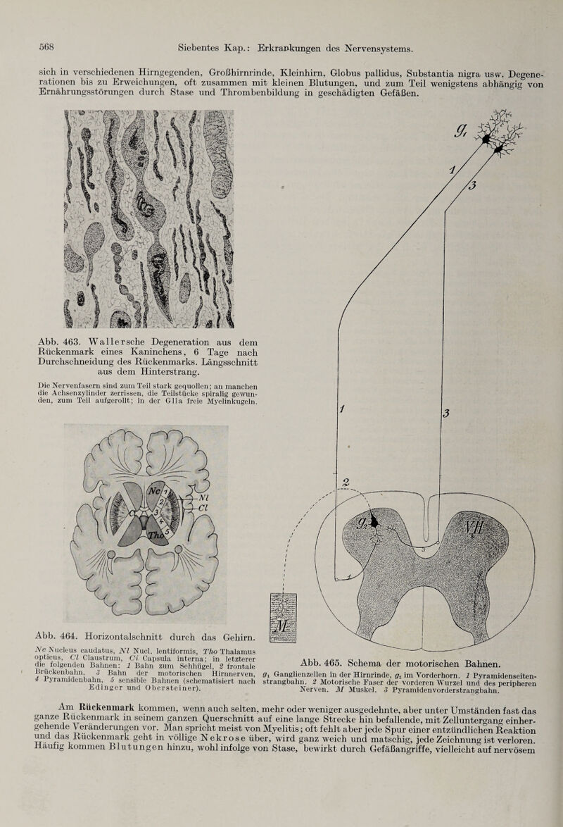 sich in verschiedenen Hirngegenden, Großhirnrinde, Kleinhirn, Globus pallidus, Substantia nigra usw. Degene¬ rationen bis zu Erweichungen, oft zusammen mit kleinen Blutungen, und zum Teil wenigstens abhängig von Ernährungsstörungen durch Stase und Thrombenbildung in geschädigten Gefäßen. Abb. 463. Waller sehe Degeneration aus dem Rückenmark eines Kaninchens, 6 Tage nach Durchschneidung des Rückenmarks. Längsschnitt aus dem Hinterstrang. Die Nervenfasern sind zum Teil stark gequollen; an manchen die Achsenzylinder zerrissen, die Teilstücke spiralig gewun¬ den, zum Teil aufgerollt; in der Glia freie Myelinkugeln. Abb. 464. Horizontalschnitt durch das Gehirn. Nc Nucleus caudatus, NI Nucl. lentiformis, Tho Thalamus opticus, CI Claustrum, Ci Capsula interna; in letzterer die folgenden Bahnen: 1 Bahn zum Sehhügel, 2 frontale Brückenbahn, 3 Bahn der motorischen Hirnnerven, 4 Pyramidenbahn, 5 sensible Bahnen (schematisiert nach Edinger und Obersteiner). Abb. 465. Schema der motorischen Bahnen. 91 Ganglienzellen in der Hirnrinde, g2 im Vorderhorn. 1 Pyramidenseiten¬ strangbahn. 2 Motorische Faser der vorderen Wurzel und des peripherer Nerven. AI Muskel. 3 Pyramidenvorderstrangbahn. Am Rückenmark kommen, wenn auch selten, mehr oder weniger ausgedehnte, aber unter Umständen fast das ganze Rückenmark in seinem ganzen Querschnitt auf eine lange Strecke hin befallende, mit Zelluntergang einher¬ gehende Veränderungen vor. Man spricht meist von Myelitis; oft fehlt aber jede Spur einer entzündlichen Reaktion und das Rückenmark geht in völlige Nekrose über, wird ganz weich und matschig, jede Zeichnung ist verloren. Häufig kommen Blutungen hinzu, wohl infolge von Stase, bewirkt durch Gefäßangriffe, vielleicht auf nervösem