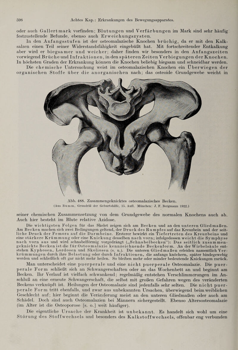 oder auch Gallert mark vorfinden; Blutungen und Verfärbungen im Mark sind sehr häufig festzustellende Befunde, ebenso auch Erweichungszysten. In den Anfangsstufen ist der osteomalazische Knochen brüchig, da er mit den Kalk¬ salzen einen Teil seiner Widerstandsfähigkeit eingebüßt hat. Mit fortschreitender Entkalkung aber wird er biegsamer und weicher; daher finden wir besonders in den Anfangszeiten vorwiegend Brüche und Infraktionen, in den späteren Zeiten Verbiegungen der Knochen. In höchsten Graden der Erkrankung können die Knochen beliebig biegsam und schneidbar werden. Die chemische Untersuchung weist im osteomalazischen Knochen ein Über wiegen der organischen Stoffe über die anorganischen nach; das osteoide Grundgewebe weicht in Abb. 488. Zusammengeknicktes osteomalazisches Becken. (Aus Bumm, Grundriß der Geburtshilfe, 15. Aufl. München: J. F. Bergmann 1922.) seiner chemischen Zusammensetzung von dem Grundgewebe des normalen Knochens auch ab. Auch hier besteht im Blute relative Azidose. Die wichtigsten Folgen für das Skelet zeigen sich am Becken und an den unteren Gliedmaßen. Am Becken machen sich zwei Bedingungen geltend, der Druck des Rumpfes auf das Kreuzbein und der seit¬ liche Druck der Femora auf die Darmbeine. Ersterer bewirkt ein Tiefertreten des Kreuzbeins und eine stärkere Krümmung oder eine Knickung desselben nach vorn; infolgedessen weicht die Symphyse nach vorn aus und wird schnabelförmig vorgedrängt („Schnabelbecken“): Das seitlich zusammen¬ geknickte Becken ist die für Osteomalazie kennzeichnende Beckenform. An der Wirbelsäule ent¬ stehen Kyphosen, Lordosen und Skoliosen (s. u.). Die unteren Gliedmaßen erleiden namentlich Ver¬ krümmungen durch ihre Belastung oder durch Infraktionen, die anfangs knöchern, später bindegewebig werden und schließlich oft gar nicht mehr heilen. So bleiben mehr oder minder bedeutende Knickungen zurück. Man unterscheidet eine puerperale und eine nicht puerperale Osteomalazie. Die puer¬ perale Form schließt sich an Schwangerschaften oder an das Wochenbett an und beginnt am Becken. Ihr Verlauf ist vielfach schwankend; regelmäßig entstehen Verschlimmerungen im An¬ schluß an eine erneute Schwangerschaft, die selbst mit großen Gefahren wegen des veränderten Beckens verknüpft ist. Heilungen der Osteomalazie sind jedenfalls sehr selten. Die nicht puer¬ perale Form tritt ebenfalls, und zwar aus unbekannten Ursachen, überwiegend beim weiblichen Geschlecht auf; hier beginnt die Veränderung meist an den unteren Gliedmaßen oder auch am Schädel. Doch sind auch Osteomalazien bei Männern sichergestellt. Ebenso Altersosteomalazie (im Alter ist die Osteoporose [s. o.] weit häufiger). Die eigentliche Ursache der Krankheit ist unbekannt. Es handelt sich wohl um eine Störung des Stoffwechsels und besonders des Kalkstoffwechsels, offenbar eng verbunden