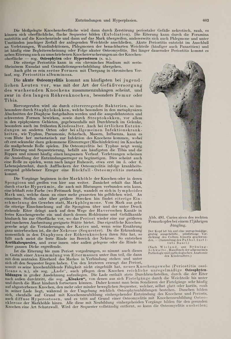 Die bloßgelegte Knochenoberfläche wird dann durch Zerstörung periostaler Gefäße nekrotisch, rauh, es können sich oberflächliche, flache Sequester bilden (Exfoliation). Die Eiterung kann durch die Foramina nutrititia auf die Knochenrinde und dann auf das Mark übergreifen, andererseits sich auch Phlegmone und unter Umständen jauchiger Zerfall der anliegenden Weichteile anschließen. Akute Periostitis entsteht im Anschluß an Verletzungen, Wundinfektionen, Phlegmonen der benachbarten Weichteile (häufiger auch Panaritien) und ist häufig eine Begleiterscheinung oder Folge akuter Osteomyelitis. Bei länger dauernder Periostitis kommt es neben Eiterung auch zu umschriebenen Knochenwucherungen an der Knochen¬ oberfläche — sog. Osteophyten oder Hyperostosen (s. u.). Die eiterige Periostitis kann in ein chronisches Stadium mit serös- fibrinösem Exsudat und Granulationsgewebsbildung übergehen. Auch gibt es rein seröse Formen mit Übergang in chronischen Ver¬ lauf, sog. Periostitis albuminosa. Die akute Osteomyelitis kommt am häufigsten bei jugend¬ lichen Leuten vor, was mit der Art der GefäßVersorgung des wachsenden Knochens zusammenzuhängen scheint, und zwar in den langen Röhrenknochen, besonders Femur oder Tibia. Hervorgerufen wird sie durch eitererregende Bakterien, so ins¬ besondere durch Staphylokokken, welche besonders in den metaphysären Abschnitten der Diaphyse festgehalten werden und die ausgedehntesten und schwersten Formen bewirken, sowie durch Streptokokken, vor allem in den epiphysären Gebieten, gegebenenfalls mit Durchbruch im Gelenke, besonders auch im frühesten Kindesalter. Auch bei örtlichen Entzün- düngen an anderen Orten oder bei allgemeinen Infektionskrank¬ heiten, wie Typhus, Pneumonie, Scharlach, Masern, Influenza, kann es vom Blute her metastatisch zur Infektion des Knochens kommen, wobei oft erst sekundär dazu gekommene Eitererreger (Mischinfektion) im Knochen die maßgebende Rolle spielen. Die Osteomyelitis bei Typhus neigt wenig zur Eiterung und Sequestrierung, befällt am häufigsten die Tibia und die Rippen und nimmt häufig einen langsamen Verlauf. Verletzungen scheinen die Ansiedlung der Entzündungserreger zu begünstigen. Dies scheint auch eine Rolle zu spielen, wenn nach langer Ruhezeit, etwa erst im 5. oder 6. Lebensjahrzehnt, durch Aufflackern der Osteomyelitis infolge krankheits¬ erregend gebliebener Erreger eine Rückfall - Osteomyelitis zustande kommt. Die Vorgänge beginnen in der Markhöhle der Knochen oder in deren Spongiosa und greifen von hier aus weiter. Zunächst erhält das Mark durch starke Hyperämie, die auch mit Blutungen verbunden sein kann, eine lebhaft rote Farbe (wo Fettmark liegt, wandelt es sich in lymphoides Mark um), welche dann zu einer mehr grauroten bis gelblichen wird. An einzelnen Stellen oder über größere Strecken hin findet eiterige Ein¬ schmelzung des Gewebes statt, Markphlegmone. Vom Mark aus geht die eiterige Einschmelzung auf die Spongiosa über und der unter Druck stehende Eiter dringt auch auf dem Wege der Hävers sehen Kanäle in festes Knochengewebe ein und durch dessen Hohlräume und Gefäßkanäle hindurch bis zur Oberfläche vor, wo das Periost wieder eine zur größeren und rascheren Ausbreitung geeignete Stätte bietet. Das eigentliche Knochen¬ gewebe zeigt die Veränderungen der Karies und, wenn seine Ernährung ganz unterbrochen ist, die der Nekrose (Sequester). Da die Erkrankung namentlich in den Diaphysen der Röhrenknochen ihren Sitz hat, so fällt auch meist die feste Rinde ins Bereich der Nekrose. So entstehen Kortikalsequester, und zwar innen oder außen gelegene oder die Rinde in ihrer ganzen Dicke ergreifende. Ist die Eiterung bis zum Periost vorgedrungen, so nimmt auch dieses in Gestalt einer Ansammlung von Eitermassen unter ihm teil, die dann mit dem zentralen Eiterherd des Markes in Verbindung stehen und unter sich oft den Sequester liegen haben. Um den letzteren erzeugt das Periost, soweit esseine knochenbildende Fähigkeit nicht eingebüßt hat, neues Knochengewebe (Periostitis ossi- ficans s. u.), als sog. „Lade“, auch pflegen dem Knochen reichliche unregelmäßige Osteophyten- bildungen in großer Ausdehnung aufzuliegen. Die Lade enthält stets Durchbruchstellen, durch die der Eiter nach außen durchtritt, die sog. „Kloaken“, von denen aus sich Fistelgänge durch die \\ eichteile bis unter und durch die Haut hindurch fortsetzen können. Daher kommt man beim Sondieren der Fistelgänge sehr häufig auf abgestorbenen Knochen, den mehr oder minder beweglichen Sequester, welcher, selbst glatt oder kariös, rauh in seiner Lade liegt, während in der Umgebung reichlich Osteophytenbildungen bestehen. Daneben bilden sich, ebenfalls auf Grund mit Knochenneubildung einhergehender Entzündung des Knochens und Peiiosts, auch diffuse Hyperostosen, und es tritt auf Grund einer Osteomyelitis mit Knochenneubildung Osteo¬ sklerose der Markhöhle hinzu. Alle diese mit Neubildung einhergehenden \ orgänge bilden füi den gesunden Knochen eine Art Schutzwall. Wird der Sequester vollständig entfernt, so kann die Osteomyelitis ausheilen, Abb. 491. Caries sicca des rechten Femurkopfes bei einem 17jährigen Jüngling. Der Kopf ist bis auf eine unregelmäßige, grubig ausgehöhlte, pilzförmige Ver¬ dickung des Collum femoris geschwun¬ den. — (Sammlung des Patho 1. Inst i- tuts Basel.) (Nach Wieland , aus Brüning- Schwalbe, Handbuch der allgemeinen Pathologie und pathologischen Anatomie des Kindesalters.)