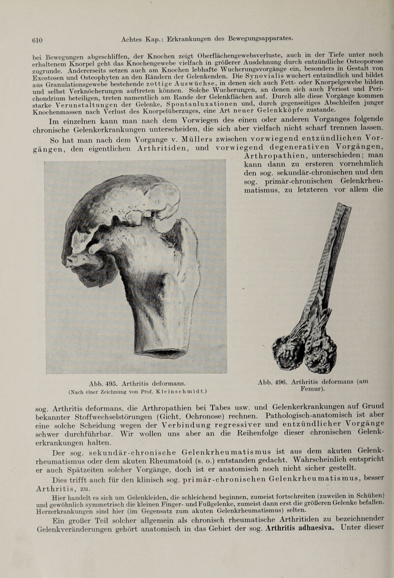 bei Bewegungen abgeschliffen, der Knochen zeigt Oberflächengewebsverluste, auch in der Tiefe unter noch erhaltenem Knorpel geht das Knochengewebe vielfach in größerer Ausdehnung durch entzündliche Osteoporose zugrunde. Andererseits setzen auch am Knochen lebhafte Wucherungsvorgänge ein, besonders in Gestalt von Exostosen und Osteophyten an den Rändern der Gelenkenden. Die Synovialis wuchert entzündlich und bildet aus Granulationsgewebe bestehende zottige Auswüchse, in denen sich auch Fett- oder Knorpelgewebe bilden und selbst Verknöcherungen auftreten kömien. Solche Wucherungen, an denen sich auch Periost und Peri- chondrium beteiligen, treten namentlich am Rande der Gelenkflächen auf. Durch alle diese Vorgänge kommen starke Verunstaltungen der Gelenke, Spontanluxationen und, durch gegenseitiges Abschleifen junger Knochenmassen nach Verlust des Knorpelüberzuges, eine Art neuer Gelenkköpfe zustande. Tm einzelnen kann man nach dem Vorwiegen des einen oder anderen Vorganges folgende chronische Gelenkerkrankungen unterscheiden, die sich aber vielfach nicht scharf trennen lassen. So hat man nach dem Vorgänge v. Müllers zwischen vorwiegend entzündlichen Vor¬ gängen, den eigentlichen Arthritiden, und vorwiegend degenerativen Vorgängen, Arthropathien, unterschieden; man kann dann zu ersteren vornehmlich den sog. sekundär-chronischen und den sog. primär-chronischen Gelenkrheu¬ matismus, zu letzteren vor allem die Abb. 495. Arthritis deformans. (Nach einer Zeichnung von Prof. Kleinschmidt.) Abb. 496. Arthritis deformans (am Femur). sog. Arthritis deformans, die Arthropathien bei Tabes usw. und Gelenkerkrankungen auf Grund bekannter Stoffwechselstörungen (Gicht, Ochronose) rechnen. Pathologisch-anatomisch ist aber eine solche Scheidung wegen der Verbindung regressiver und entzündlicher Vorgänge schwer durchführbar. Wir wollen uns aber an die Reihenfolge dieser chronischen Gelenk¬ erkrankungen halten. Der sog. sekundär-chronische Gelenkrheumatismus ist aus dem akuten Gelenk¬ rheumatismus oder dem akuten Rheumatoid (s. o.) entstanden gedacht. Wahrscheinlich entspricht er auch Spätzeiten solcher Vorgänge, doch ist er anatomisch noch nicht sicher gestellt. Dies trifft auch für den klinisch sog. primär-chronischen Gelenkrheumatismus, besser Arthritis, zu. Hier handelt es sich um Gelenkleiden, die schleichend beginnen, zumeist fortschreiten (zuweilen in Schüben) und gewöhnlich symmetrisch die kleinen Finger- und Fußgelenke, zumeist dann erst die größeren Gelenke befallen. Herzerkrankungen sind hier (im Gegensatz zum akuten Gelenkrheumatismus) selten. Ein großer Teil solcher allgemein als chronisch rheumatische Arthritiden zu bezeichnender Gelenkveränderungen gehört anatomisch in das Gebiet der sog. Arthritis adliaesiva. Unter dieser