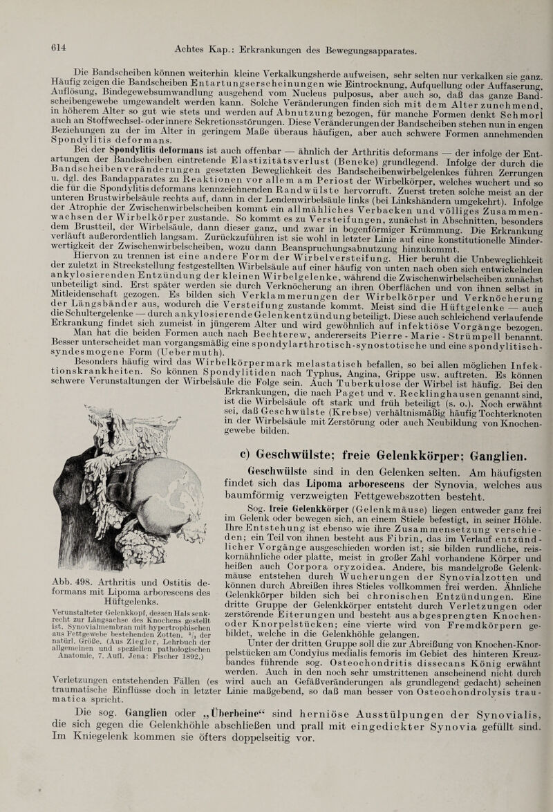 ,Die Bandscheiben können weiterhin kleine Verkalkungsherde aufweisen, sehr selten nur verkalken sie oanz. Häufig zeigen die Bandscheiben Entartungserscheinungenwie Eintrocknung, Aufquellung oder Auffaserung Auflösung, Bmdegewebsumwandlung ausgehend vom Nucleus pulposus, aber auch so, daß das ganze Band¬ scheibengewebe umgewandelt werden kann. Solche Veränderungen finden sich mit dem Alterzunehmend in höherem Alter so gut wie stets und werden auf Abnutzung bezogen, für manche Formen denkt Schmorl auch an Stoffwechsel- oder innere Sekretionsstörungen. Diese Veränderungen der Bandscheiben stehen nun in engen Beziehungen zu der im Alter in geringem Maße überaus häufigen, aber auch schwere Formen annehmenden Spondylitis delormans. Bei der Spondylitis deformans ist auch offenbar — ähnlich der Arthritis deformans — der infolge der Ent¬ artungen der Bandscheiben eintretende Elastizitätsverlust (Beneke) grundlegend. Infolge de? durch die Bandscheiben Veränderungen gesetzten Beweglichkeit des Bandscheibenwirbelgelenkes führen Zerrungen Cf Bandapparates zu Reaktionen vor allem am Periost der Wirbelkörper, welches wuchert und so die für die Spondylitis deformans kennzeichnenden Randwülste hervorruft. Zuerst treten solche meist an der unteren Brustwirbelsäule rechts auf, dann in der Lendenwirbelsäule links (bei Linkshändern umgekehrt) Infohre der Atrophie der Zwischenwirbelscheiben kommt ein allmähliches Verbacken und völliges Zusammen¬ wachsen der Wir beikörper zustande. So kommt es zu Versteifungen, zunächst in Abschnitten, besonders cler?„ Brustteil, der YY lrbelsäule, dann dieser ganz, und zwar in bogenförmiger Krümmung. Die Erkrankung verlauft außerordentlich langsam. Zurückzuführen ist sie wohl in letzter Linie auf eine konstitutionelle Minder¬ wertigkeit der Zwischenwirbelscheiben, wozu dann Beanspruchungsabnutzung hinzukommt. Hiervon zu trennen ist eine andere Form der Wirbelversteifung. Hier beruht die Unbeweglichkeit der zuletzt m Streckstellung festgestellten Wirbelsäule auf einer häufig von unten nach oben sich entwi?kelnden a i \ o?ier?ncl ^Entzündung der kleinen Wirbelgelenke, während die Zwischen wir beischeiben zunächst lVn?,et?llgt ,S1, Erst Spatf werden sie dlirch Verknöcherung an ihren Oberflächen und von ihnen selbst in Mitleidenschaft gezogen. Es bilden sich Verklammerungen der Wirbelkörper und Verknöcherung der Langsbanc er aus, wodurch die Versteifung zustande kommt. Meist sind die Hüftgelenke — auch die Schultergelenke — durch ankylosierende Gelenkentzündungbeteiligt. Diese auch schleichend verlaufende Erkrankung findet sich zumeist in jüngerem Alter und wird gewöhnlich auf infektiöse Vorgänge bezogen Man hat die beiden Formen auch nach Bechterew, andererseits Pierre - Marie - Strümpell benannt Besser unterscheidet man vorgangsmäßig eine spondylarthrotisch-synostotische und eine spondylitisch- syndesmogene Form (Uebermuth). J Besonders häufig wird das Wirbelkörper mark melastatisch befallen, so bei allen möglichen Infek¬ tionskrankheiten. So können Spondylitiden nach Typhus, Angina, Grippe usw. auftreten. Es können schwere Verunstaltungen der Wirbelsäule die Folge sein. Auch Tuberkulose der Wirbel ist häufig. Bei den Erkrankungen, die nach Paget und v. Recklinghausen genannt sind, ist die Wirbelsäule oft stark und früh beteiligt (s. o.). Noch erwähnt sei, daß Geschwülste (Krebse) verhältnismäßig häufig Tochterknoten in der Wirbelsäule mit Zerstörung oder auch Neubildung von Knochen¬ gewebe bilden. c) Geschwülste; freie Gelenkkörper; Ganglien. Geschwülste sind in den Gelenken selten. Am häufigsten findet sich das Lipoma arborescens der Synovia, welches aus baumförmig verzweigten Fettgewebszotten besteht. Sog. freie CJelenkkörper (Gelenkmäuse) liegen entweder ganz frei im Gelenk oder bewegen sich, an einem Stiele befestigt, in seiner Höhle. Ihre Entstehung ist ebenso wie ihre Zusammensetzung verschie¬ den; ein Teil von ihnen besteht aus Fibrin, das im Verlauf entzünd¬ licher Vorgänge ausgeschieden worden ist; sie bilden rundliche, reis¬ kornähnliche oder platte, meist in großer Zahl vorhandene Körper und heißen auch Corpora oryzoidea. Andere, bis mandelgroße Gelenk¬ mäuse entstehen durch Wucherungen der Synovialzotten und können durch Abreißen ihres Stieles vollkommen frei werden. Ähnliche Gelenkkörper bilden sich bei chronischen Entzündungen. Eine dritte Gruppe der Gelenkkörper entsteht durch Verletzungen oder zerstörende Eiterungen und besteht aus abgesprengten Knochen¬ oder Knorpelstücken; eine vierte wird von Fremdkörpern ge¬ bildet, welche in die Gelenkhöhle gelangen. Unter der dritten Gruppe soll die zur Abreibung von Knochen-Knor¬ pelstücken am Condylus medialis femoris im Gebiet des hinteren Kreuz¬ bandes führende sog. Osteochondritis dissecans König erwähnt werden. Auch in den noch sehr umstrittenen anscheinend nicht durch Verletzungen entstehenden Fällen (es wird auch an Gefäßveränderungen als grundlegend gedacht) scheinen traumatische Einflüsse doch in letzter Linie maßgebend, so daß man besser von Osteochondrolysis trau¬ matica spricht. Die sog. Ganglien oder „ Überbeine“ sind herniöse Ausstülpungen der Synovialis, die sich gegen die Gelenkhöhle abschließen und prall mit eingedickter Synovia gefüllt sind. Im Kniegelenk kommen sie öfters doppelseitig vor. Abb. 498. Arthritis und Ostitis de¬ formans mit Lipoma arborescens des Hüftgelenks. Verunstalteter Gelenkkopf, dessen Hals senk¬ recht zur Längsachse des Knochens gestellt ist. Synovialmembran mit hypertrophischen aus Fettgewebe bestehenden Zotten. 2/3 der natürl. Größe. (Aus Ziegler, Lehrbuch der allgemeinen und speziellen pathologischen Anatomie, 7. Aufl. Jena: Fischer 1892.)