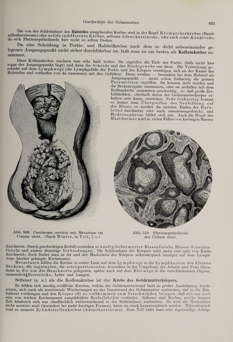 Geschwülste der Gebärmutter. Die von der Schleimhaut des Halsteiles ausgehenden Krebse sind in der Regel Krompecherkrebse (Basal- zellenkamnome)oder solide ind.tferenteKrebse, seltener Adenokarzinome, oderauch echte Kankroide da sich Plattenepithelinseln hier nicht so selten finden. ’ Da eine Scheidung in Portio- und Halsteilkrebse nach dem so dicht nebeneinander ge legenen Ausgangspunkt nicht sicher durchführbar ist, faßt man sie am besten als Kollumkrebse zu sammen. Diese Kollumkrebse wachsen nun sehr bald weiter. Sie ergreifen die Tiefe der Portio (falls nicht hier SOf^rT fer Ausgangspunkt hegt) und dann die Scheide und das Bindegewebe um diese. Die Verbreitung ge¬ schieht auf dem Lvmphwege (die Lymphgefäße der Portio und des Körpers vereinigen sich an der Kante des Ha eiles und verlaufen von da zusammen mit den Gefäßen). Dann werden — besonders bei dem Halsteil als Ausgangspunkt — meist schon frühzeitig die ganzen Parametrien ergriffen. Sie können derb werden und die Beckenorgane ummauern, oder sie zerfallen mit dem Kollumkrebs zusammen geschwürig, so daß große Zer¬ fallshöhlen, oberhalb deren der Gebärmutterkörper er¬ halten sein kann, entstehen. Sehr frühzeitig kommt es ferner zum Übergreifen der Neubildung auf die Blase; es werden die unteren Enden der Harn¬ leiter durchsetzt oder auch zusammengedrückt, und f Hydronephrose bildet sich aus. Auch die Wand des Mastdarmes wird in vielen Fällen von krebsigen Massen Abb. 509. Carcinoma cervicis mit Metastase im Corpus uteri. (Nach Winter, in Veit, 1. c.) Abb. 510. Plattenepithelkrebs des Collum uteri. durchsetzt. Durch geschwürigenZerfall entstehen so häufig Gebärmutter-Blasenfisteln, Blasen-Scheiden- fisteln und andere derartige Verbindungen. Die Schleimhaut des Körpers wird meist erst spät von Krebs durchsetzt; doch findet man in ihr und der Muskularis des Körpers mikroskopisch häufiger auf dem Lymph- wege hierher gelangte Krebsnester. Metastasen bilden die Krebse in erster Linie auf dem Lymphwege in die Lymphknoten des kleinen Beck ens, die inguinalen, die retroperitonealen, besonders in der Umgebung der Arteria und Vena iliaca, dann in die um die Bauchaorta gelegenen, später auch auf dem Blutwege in die verschiedensten Organe, namentlichjEierstöcke, Leber und Lungen. Seltener (s. u.) als die Kollumkrebse ist der Krebs des Gebärmutterkörpers. Es bilden sich markig-weißliche Knoten, welche die Gebärmutterwand bald in großer Ausdehnung durch¬ setzen, sich auch als zerstörende Wucherungen an der Innenwand der Gebärmutter ausbreiten, tief in die Mus¬ kulatur Vordringen und den Körper oft so vollkommen zum Verschwinden bringen, daß sich nur noch eine von reichen Krebsmassen ausgekleidete Zerfallshöhle vorfindet. Seltener sind Krebse, welche längere Zeit hindurch sich nur oberflächlich weiterwuchernd in der Schleimhaut ausbreiten. So weit die Muskulatur nicht zerstört wird (besonders bei mehr knotigen Formen), kann sie stark hypertrophisch werden. Mikroskopisch sind es zumeist Zylinderzellenkrebse (Adenokarzinome). Zum Teil sieht man sehr regelmäßige drüsige