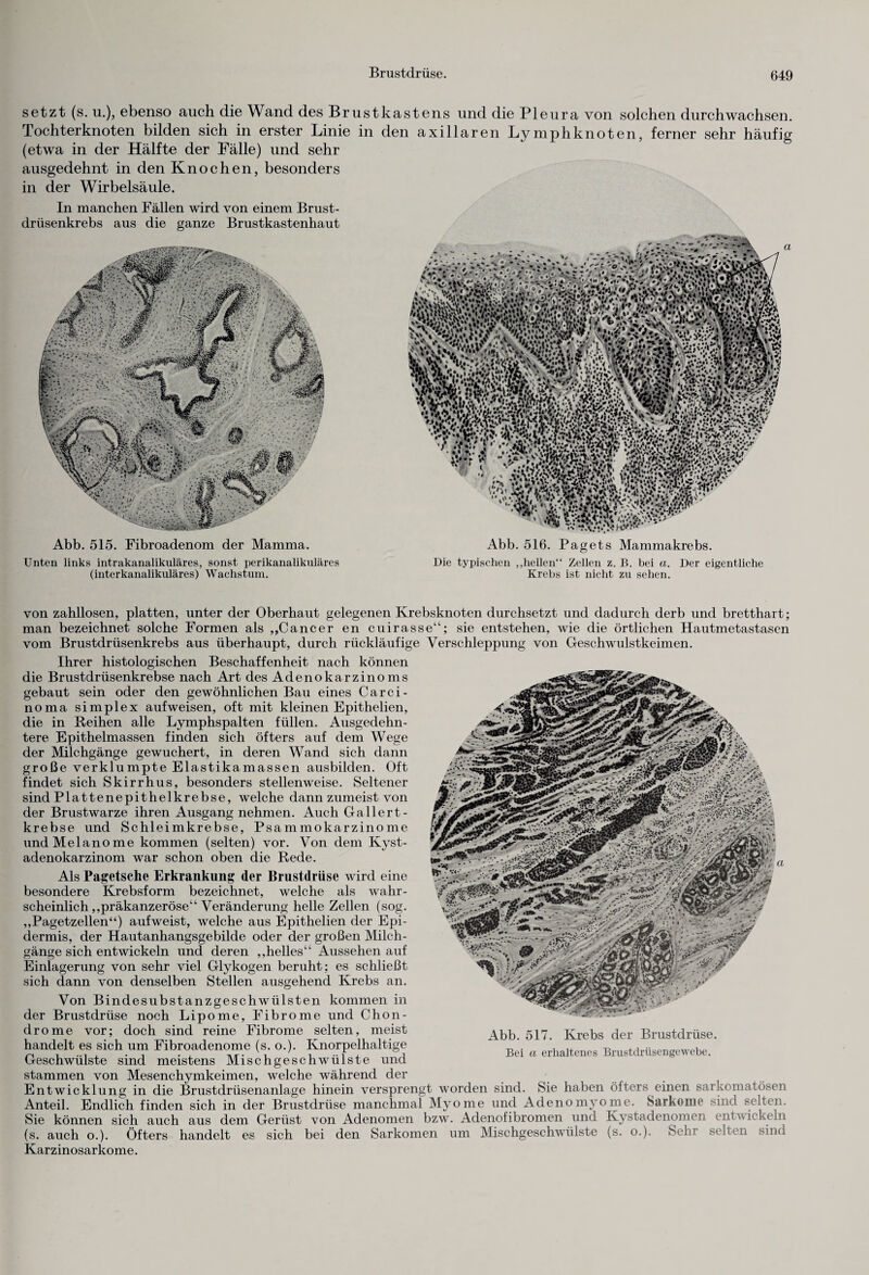 setzt (s. u.), ebenso auch die Wand des Brustkastens und die Pleura von solchen durchwachsen. Tochterknoten bilden sich in erster Linie in den axillaren Lymphknoten, ferner sehr häufig (etwa in der Hälfte der Fälle) und sehr ausgedehnt in den Knochen, besonders in der Wirbelsäule. In manchen Fällen wird von einem Brust¬ drüsenkrebs aus die ganze Brustkastenhaut Abb. 515. Fibroadenom der Mamma. Abb. 516. Pagets Mammakrebs. Unten links intrakanalikuläres, sonst perikanalikuläres Die typischen „hellen“ Zellen z. B. bei a. Der eigentliche (interkanalikuläres) Wachstum. Krebs ist nicht zu sehen. von zahllosen, platten, unter der Oberhaut gelegenen Krebsknoten durchsetzt und dadurch derb und bretthart; man bezeichnet solche Formen als „Cancer en cuirasse“; sie entstehen, wie die örtlichen Hautmetastasen vom Brustdrüsenkrebs aus überhaupt, durch rückläufige Verschleppung von Geschwulstkeimen. Ihrer histologischen Beschaffenheit nach können die Brustdrüsenkrebse nach Art des Adenokarzinoms gebaut sein oder den gewöhnlichen Bau eines Carci¬ noma simplex auf weisen, oft mit kleinen Epithelien, die in Reihen alle Lymphspalten füllen. Ausgedehn¬ tere Epithelmassen finden sich öfters auf dem Wege der Milchgänge gewuchert, in deren Wand sich dann große verklumpte Elastikamassen ausbilden. Oft findet sich Skirrhus, besonders stellenweise. Seltener sind Plattenepithelkrebse, welche dann zumeist von der Brustwarze ihren Ausgang nehmen. Auch Gal ler t- krebse und Schleimkrebse, Psammokarzinome und Melanome kommen (selten) vor. Von dem Kyst- adenokarzinom war schon oben die Rede. Als Pagetsche Erkrankung der Brustdrüse wird eine besondere Krebsform bezeichnet, welche als wahr¬ scheinlich „präkanzeröse“ Veränderung helle Zellen (sog. „Pagetzellen“) aufweist, welche aus Epithelien der Epi¬ dermis, der Hautanhangsgebilde oder der großen Milch¬ gänge sich entwickeln und deren „helles“ Aussehen auf Einlagerung von sehr viel Glykogen beruht; es schließt sich dann von denselben Stellen ausgehend Krebs an. Von Bindesubstanzgeschwülsten kommen in der Brustdrüse noch Lipome, Fibrome und Chon¬ drome vor; doch sind reine Fibrome selten, meist handelt es sich um Fibroadenome (s. o.). Knorpelhaltige Geschwülste sind meistens Mischgeschwülste und stammen von Mesenchymkeimen, welche während der Entwicklung in die Brustdrüsenanlage hinein versprengt worden sind. Sie haben öfters einen sarkomatösen Anteil. Endlich finden sich in der Brustdrüse manchmal Myome und Adenomyome. Sarkome sind selten. Sie können sich auch aus dem Gerüst von Adenomen bzw. Adenofibromen und Kystadenomen entwickeln (s. auch o.). Öfters handelt es sich bei den Sarkomen um Mischgeschwülste (s. o.). Sehr selten sind Karzinosarkome. Abb. 517. Krebs der Brustdrüse. Bei ci erhaltenes Brustdrüsengewebe.