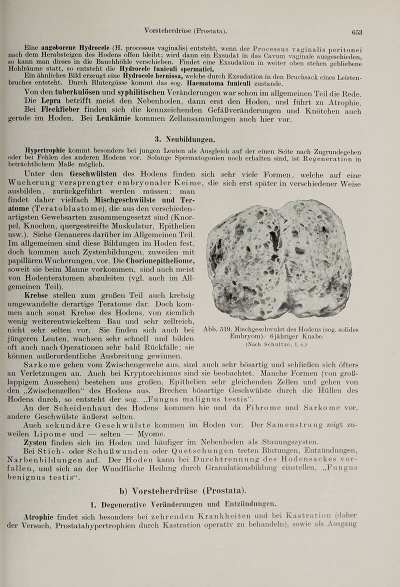 Eine angeborene Hydrocele (H. processus vaginalis) entsteht, wenn der Processus vaginalis peritonei nach dem Herabsteigen des Hodens offen bleibt; wird dann ein Exsudat in das Cavum vaginale ausgeschieden, so kann man dieses in die Bauchhöhle verschieben. Findet eine Exsudation in weiter oben stehen^ebliebene Hohlräume statt, so entsteht die Hydrocele funiculi spermatici. Ein ähnliches Bild erzeugt eine Hydrocele herniosa, welche durch Exsudation in den Bruchsack eines Leisten¬ bruches entsteht. Durch Blutergüsse kommt das sog. Haematoma funiculi zustande. Von den tuberkulösen und syphilitischen Veränderungen war schon im allgemeinen Teil die Rede. Die Lepra betrifft meist den Nebenhoden, dann erst den Hoden, und führt zu Atrophie. Bei Fleckfieber finden sich die kennzeichenden Gefäßveränderungen und Knötchen auch gerade im Hoden. Bei Leukämie kommen Zellansammlungen auch hier vor. 3. Neubildungen. Hypertrophie kommt besonders bei jungen Leuten als Ausgleich auf der einen Seite nach Zugrundegehen oder bei Fehlen des anderen Hodens vor. Solange Spermatogonien noch erhalten sind, ist Regeneration in beträchtlichem Maße möglich. Unter den Geschwülsten des Hodens finden sich sehr viele Formen, welche auf eine Wucherung versprengter embryonaler Keime, die sich erst später in verschiedener Weise ausbilden, zurückgeführt werden müssen; man findet daher vielfach Mischgeschwülste und Ter¬ atome (Teratoblasto me), die aus den verschieden¬ artigsten Gewebsarten zusammengesetzt sind (Knor¬ pel, Knochen, quergestreifte Muskulatur, Epithelien usw.). Siehe Genaueres darüber im Allgemeinen Teil. Im allgemeinen sind diese Bildungen im Hoden fest, doch kommen auch Zystenbildungen, zuweilen mit papillären Wucherungen, vor. Die Chorionepitheliome, soweit sie beim Manne Vorkommen, sind auch meist von Hodenteratomen abzuleiten (vgl. auch im All¬ gemeinen Teil). Krebse stellen zum großen Teil auch krebsig umgewandelte derartige Teratome dar. Doch kom¬ men auch sonst Krebse des Hodens, von ziemlich wenig weiterentwickeltem Bau und sehr zellreich, nicht sehr selten vor. Sie finden sich auch bei Abb. 519. Mischgeschwulst des Hodens (sog. solides jüngeren Leuten, wachsen sehr schnell und bilden Embryom). 6jähriger Knabe, oft auch nach Operationen sehr bald Rückfälle; sie (Nach Scluiltze’ c') können außerordentliche Ausbreitung gewinnen. Sarkome gehen vom Zwischengewebe aus, sind auch sehr bösartig und schließen sich öfters an Verletzungen an. Auch bei Kryptorchismus sind sie beobachtet. Manche Formen (von groß- lappigem Aussehen) bestehen aus großen, Epithelien sehr gleichenden Zellen und gehen von den „Zwischenzellen“ des Hodens aus. Brechen bösartige Geschwülste durch die Hüllen des Hodens durch, so entsteht der sog. „Fungus malignus testis“. An der Scheidenhaut des Hodens kommen hie und da Fibrome und Sarkome vor, andere Geschwülste äußerst selten. Auch sekundäre Geschwülste kommen im Hoden vor. Der Samenstrang zeigt zu¬ weilen Lipome und — selten — Myome. Zysten finden sich im Hoden und häufiger im Nebenhoden als Stauungszysten. Bei Stich- oder Schußwunden oder Quetschungen treten Blutungen, Entzündungen, Narbenbildungen auf. Der Hoden kann bei Durchtrennung des Hodensackes vor¬ fallen, und sich an der Wundfläche Heilung durch Granulationsbildung einstellen, „Fungus benignus testis“. b) Vorsteherdrüse (Prostata). 1. Degenerative Veränderungen und Entzündungen. Atrophie findet sich besonders bei zehrenden Krankheiten und bei Kastration (daher der Versuch, Prostatahypertrophien durch Kastration operativ zu behandeln), sowie als Ausgang