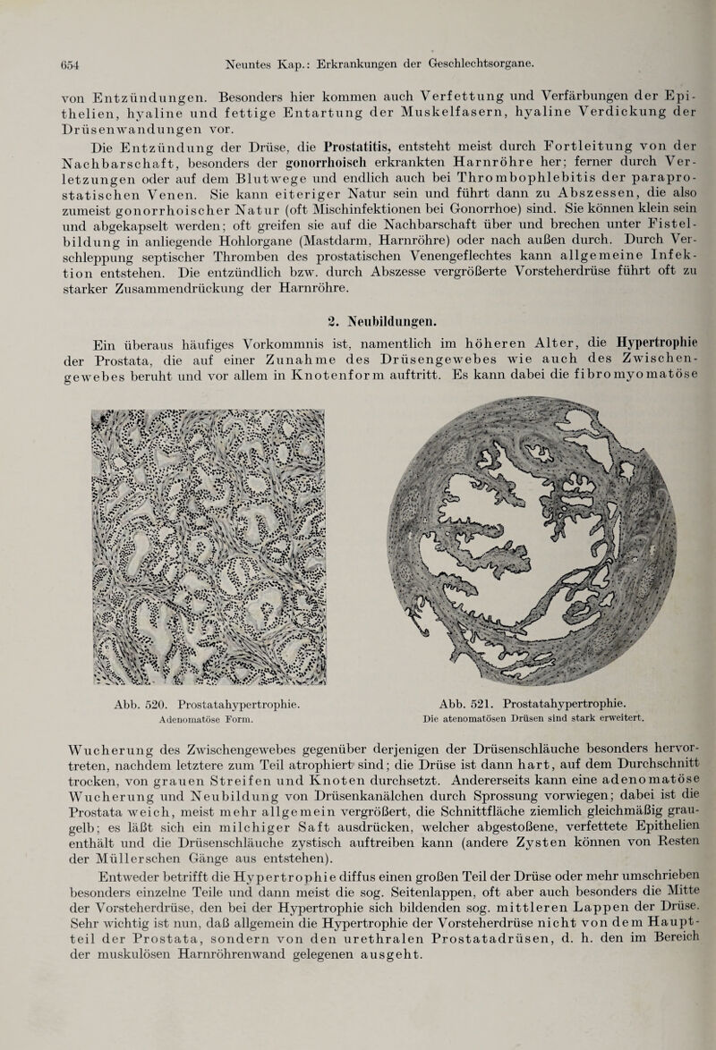 von Entzündungen. Besonders hier kommen auch Verfettung und Verfärbungen der Epi- thelien, hyaline und fettige Entartung der Muskelfasern, hyaline Verdickung der Drüsenwandungen vor. Die Entzündung der Drüse, die Prostatitis, entsteht meist durch Fortleitung von der Nachbarschaft, besonders der gonorrhoisch erkrankten Harnröhre her; ferner durch Ver¬ letzungen oder auf dem Blutwege und endlich auch bei Thrombophlebitis der parapro- statischen Venen. Sie kann eiteriger Natur sein und führt dann zu Abszessen, die also zumeist gonorrhoischer Natur (oft Mischinfektionen bei Gonorrhoe) sind. Sie können klein sein und abgekapselt werden; oft greifen sie auf die Nachbarschaft über und brechen unter Fistel- bildung in anliegende Hohlorgane (Mastdarm, Harnröhre) oder nach außen durch. Durch Ver¬ schleppung septischer Thromben des prostatischen Venengeflechtes kann allgemeine Infek¬ tion entstehen. Die entzündlich bzw. durch Abszesse vergrößerte Vorsteherdrüse führt oft zu starker Zusammendrückung der Harnröhre. 2. Neubildungen. Ein überaus häufiges Vorkommnis ist, namentlich im höheren Alter, die Hypertrophie der Prostata, die auf einer Zunahme des Drüsengewebes wie auch des Zwischen¬ gewebes beruht und vor allem in Knotenform auftritt. Es kann dabei die fibromyomatöse Abb. 520. Prostatahypertrophie. Adenomatöse Form. Abb. 521. Prostatahypertrophie. Die atenomatösen Drüsen sind stark erweitert. Wucherung des Zwischengewebes gegenüber derjenigen der Drüsenschläuche besonders hervor¬ treten, nachdem letztere zum Teil atrophiert sind; die Drüse ist dann hart, auf dem Durchschnitt trocken, von grauen Streifen und Knoten durchsetzt. Andererseits kann eine adenomatöse Wucherung und Neubildung von Drüsenkanälchen durch Sprossung vorwiegen; dabei ist die Prostata weich, meist mehr allgemein vergrößert, die Schnittfläche ziemlich gleichmäßig grau¬ gelb; es läßt sich ein milchiger Saft ausdrücken, welcher abgestoßene, verfettete Epithelien enthält und die Drüsenschläuche zystisch auftreiben kann (andere Zysten können von Resten der Müll er sehen Gänge aus entstehen). Entweder betrifft die Hypertrophie diffus einen großen Teil der Drüse oder mehr umschrieben besonders einzelne Teile und dann meist die sog. Seitenlappen, oft aber auch besonders die Mitte der Vorsteherdrüse, den bei der Hypertrophie sich bildenden sog. mittleren Lappen der Drüse. Sehr wichtig ist nun, daß allgemein die Hypertrophie der Vorsteherdrüse nicht von dem Haupt- teil der Prostata, sondern von den urethralen Prostatadrüsen, d. h. den im Bereich der muskulösen Harnröhrenwand gelegenen ausgeht.