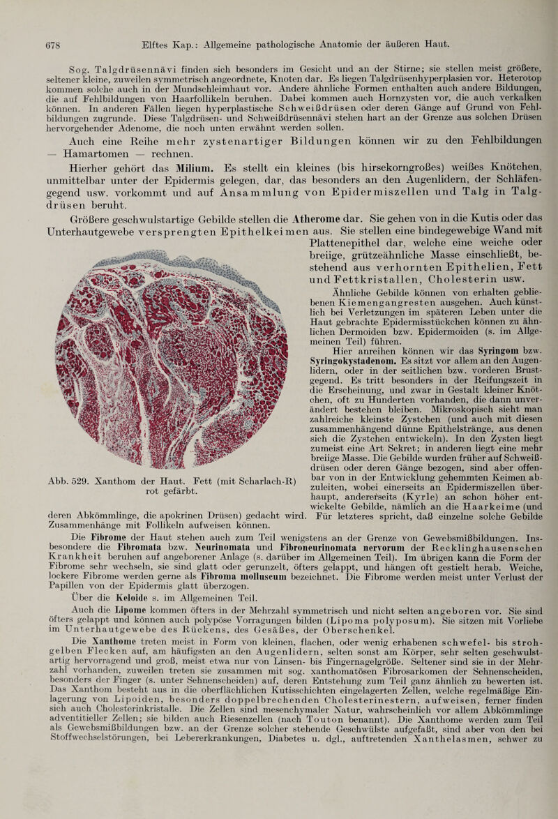 Sog. Talgdrüsennävi finden sich besonders im Gesicht und an der Stirne; sie stellen meist größere, seltener kleine, zuweilen symmetrisch angeordnete, Knoten dar. Es liegen Talgdrüsenhyperplasien vor. Heterorop kommen solche auch in der Mundschleimhaut vor. Andere ähnliche Formen enthalten auch andere Bildungen, die auf Fehlbildungen von Haarfollikeln beruhen. Dabei kommen auch Hornzysten vor, die auch verkalken können. In anderen Fällen liegen hyperplastische Schweißdrüsen oder deren Gänge auf Grund von Fehl- bildungen zugrunde. Diese Talgdrüsen- und Schweißdrüsennävi stehen hart an der Grenze aus solchen Drüsen hervorgehender Adenome, die noch unten erwähnt werden sollen. Auch eine Reihe mehr zystenartiger Bildungen können wir zu den Fehlbildungen — Hamartomen — rechnen. Hierher gehört das Milium. Es stellt ein kleines (bis hirsekorngroßes) weißes Knötchen, unmittelbar unter der Epidermis gelegen, dar, das besonders an den Augenlidern, der Schläfen¬ gegend usw. vorkommt und auf Ansammlung von Epidermiszellen und Talg in Talg¬ drüsen beruht. Größere geschwulstartige Gebilde stellen die Atherome dar. Unterhautgewebe versprengten Epithelkeimen aus. Abb. 529. Xanthom der Haut. Fett (mit Scharlach-R) rot gefärbt. deren Abkömmlinge, die apokrinen Drüsen) gedacht wird. Zusammenhänge mit Follikeln aufweisen können. Sie gehen von in die Kutis oder das Sie stellen eine bindegewebige Wand mit Plattenepithel dar, welche eine weiche oder breiige, grützeähnliche Masse einschließt, be¬ stehend aus verhornten Epithelien, Fett und Fettkristallen, Cholesterin usw. Ähnliche Gebilde können von erhalten geblie¬ benen Kiemengangresten ausgehen. Auch künst¬ lich bei Verletzungen im späteren Leben unter die Haut gebrachte Epidermisstückchen können zu ähn¬ lichen Dermoiden bzw. Epidermoiden (s. im Allge¬ meinen Teil) führen. Hier anreihen können wir das Syringom bzw. Syriügokystadenom. Es sitzt vor allem an den Augen¬ lidern, oder in der seitlichen bzw. vorderen Brust¬ gegend. Es tritt besonders in der Reifungszeit in die Erscheinung, und zwar in Gestalt kleiner Knöt¬ chen, oft zu Hunderten vorhanden, die dann unver¬ ändert bestehen bleiben. Mikroskopisch sieht man zahlreiche kleinste Zystchen (und auch mit diesen zusammenhängend dünne Epithelstränge, aus denen sich die Zystchen entwickeln). In den Zysten liegt zumeist eine Art Sekret; in anderen liegt eine mehr breiige Masse. Die Gebilde wurden früher auf Schweiß¬ drüsen oder deren Gänge bezogen, sind aber offen¬ bar von in der Entwicklung gehemmten Keimen ab¬ zuleiten, wobei einerseits an Epidermiszellen über¬ haupt, andererseits (Kyrie) an schon höher ent¬ wickelte Gebilde, nämlich an die Haarkeime (und Für letzteres spricht, daß einzelne solche Gebilde Die Fibrome der Haut stehen auch zum Teil wenigstens an der Grenze von Gewebsmißbildungen. Ins¬ besondere die Fibromata bzw. Neurinomata und Fibroneurinomata nervorum der Recklinghausenschen Krankheit beruhen auf angeborener Anlage (s. darüber im Allgemeinen Teil). Im übrigen kann die Form der Fibrome sehr wechseln, sie sind glatt oder gerunzelt, öfters gelappt, und hängen oft gestielt herab. Weiche, lockere Fibrome werden gerne als Fibroma molluscum bezeichnet. Die Fibrome werden meist unter Verlust der Papillen von der Epidermis glatt überzogen. Über die Keloide s. im Allgemeinen Teil. Auch die Lipome kommen öfters in der Mehrzahl symmetrisch und nicht selten angeboren vor. Sie sind öfters gelappt und können auch polypöse Vorragungen bilden (Lipoma polyposum). Sie sitzen mit Vorliebe im Unterhautgewebe des Rückens, des Gesäßes, der Oberschenkel. Die Xanthome treten meist in Form von kleinen, flachen, oder wenig erhabenen Schwefel- bis stroh¬ gelben Flecken auf, am häufigsten an den Augenlidern, selten sonst am Körper, sehr selten geschwulst¬ artig hervorragend und groß, meist etwa nur von Linsen- bis Fingernagelgröße. Seltener sind sie in der Mehr¬ zahl vorhanden, zuweilen treten sie zusammen mit sog. Xanthomatosen Fibrosarkomen der Sehnenscheiden, besonders der Finger (s. unter Sehnenscheiden) auf, deren Entstehung zum Teil ganz ähnlich zu bewerten ist. Das Xanthom besteht aus in die oberflächlichen Kutisschichten eingelagerten Zellen, welche regelmäßige Ein¬ lagerung von Lipoiden, besonders doppelbrechenden Cholesterinestern, aufweisen, ferner finden sich auch Cholesterinkristalle. Die Zellen sind mesenchymaler Natur, wahrscheinlich vor allem Abkömmlinge adventitieller Zellen; sie bilden auch Riesenzellen (nach Touton benannt). Die Xanthome werden zum Teil als Gewebsmißbildungen bzw. an der Grenze solcher stehende Geschwülste aufgefaßt, sind aber von den bei Stoffwechselstörungen, bei Lebererkrankungen, Diabetes u. dgl., auftretenden Xanthelasmen, schwer zu
