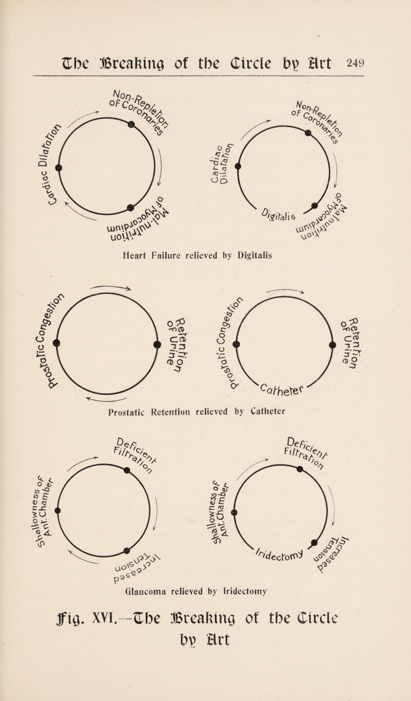 Heart Failure relieved by Digitalis Prostatic Retention relieved by Catheter fig. XVI.—Cbe Breaking of tbe Circle bv art