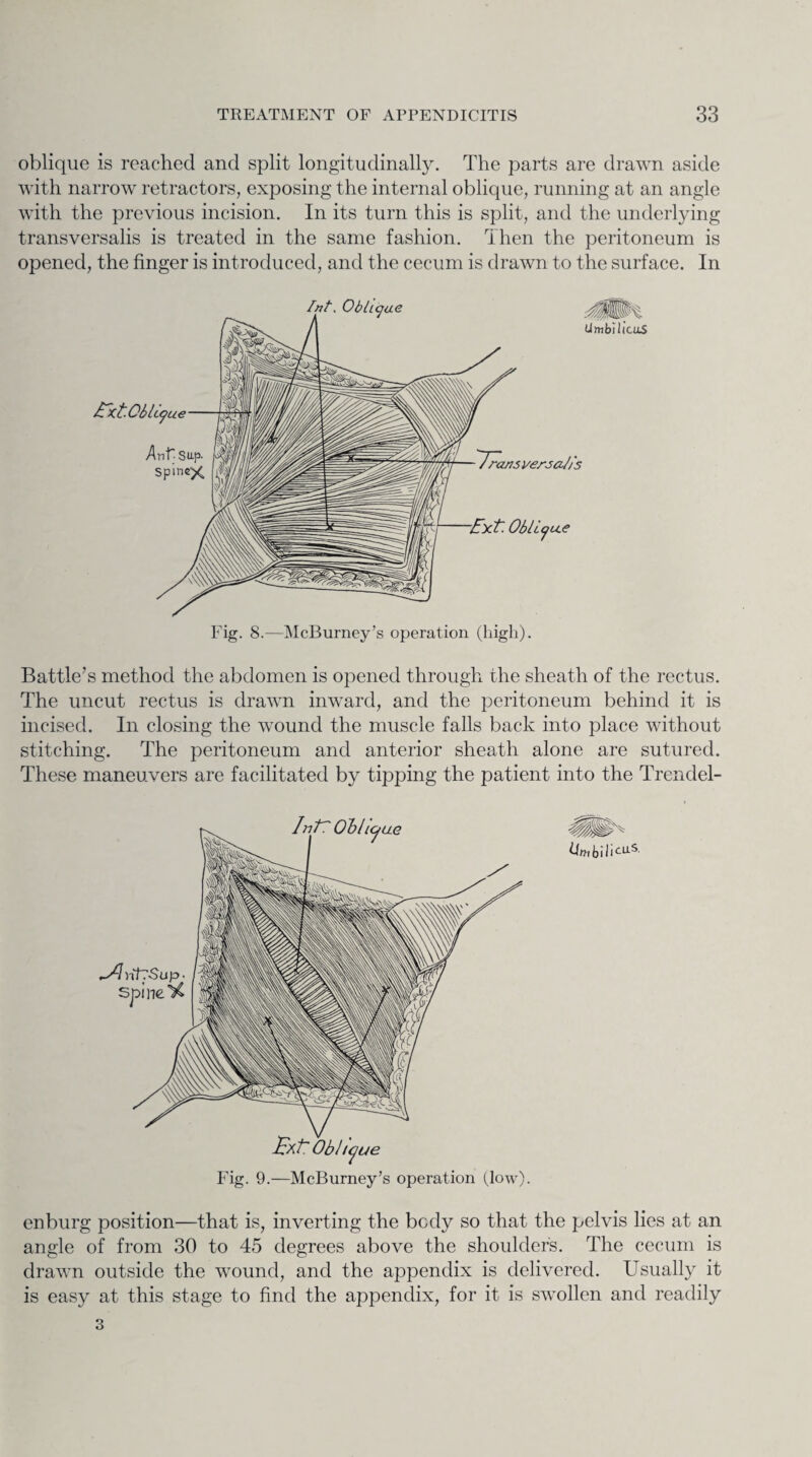 oblique is reached and split longitudinally. The parts are drawn aside with narrow retractors, exposing the internal oblique, running at an angle with the previous incision. In its turn this is split, and the underlying transversalis is treated in the same fashion. Then the peritoneum is opened, the finger is introduced, and the cecum is drawn to the surface. In Fig. 8.—McBurney’s operation (high). Battle’s method the abdomen is opened through the sheath of the rectus. The uncut rectus is drawn inward, and the peritoneum behind it is incised. In closing the wound the muscle falls back into place without stitching. The peritoneum and anterior sheath alone are sutured. These maneuvers are facilitated by tipping the patient into the Trenclel- Ex't Oblique Fig. 9.—McBurney’s operation (low). enburg position—that is, inverting the body so that the pelvis lies at an angle of from 30 to 45 degrees above the shoulder's. The cecum is drawn outside the wound, and the appendix is delivered. Usually it is easy at this stage to find the appendix, for it is swollen and readily 3