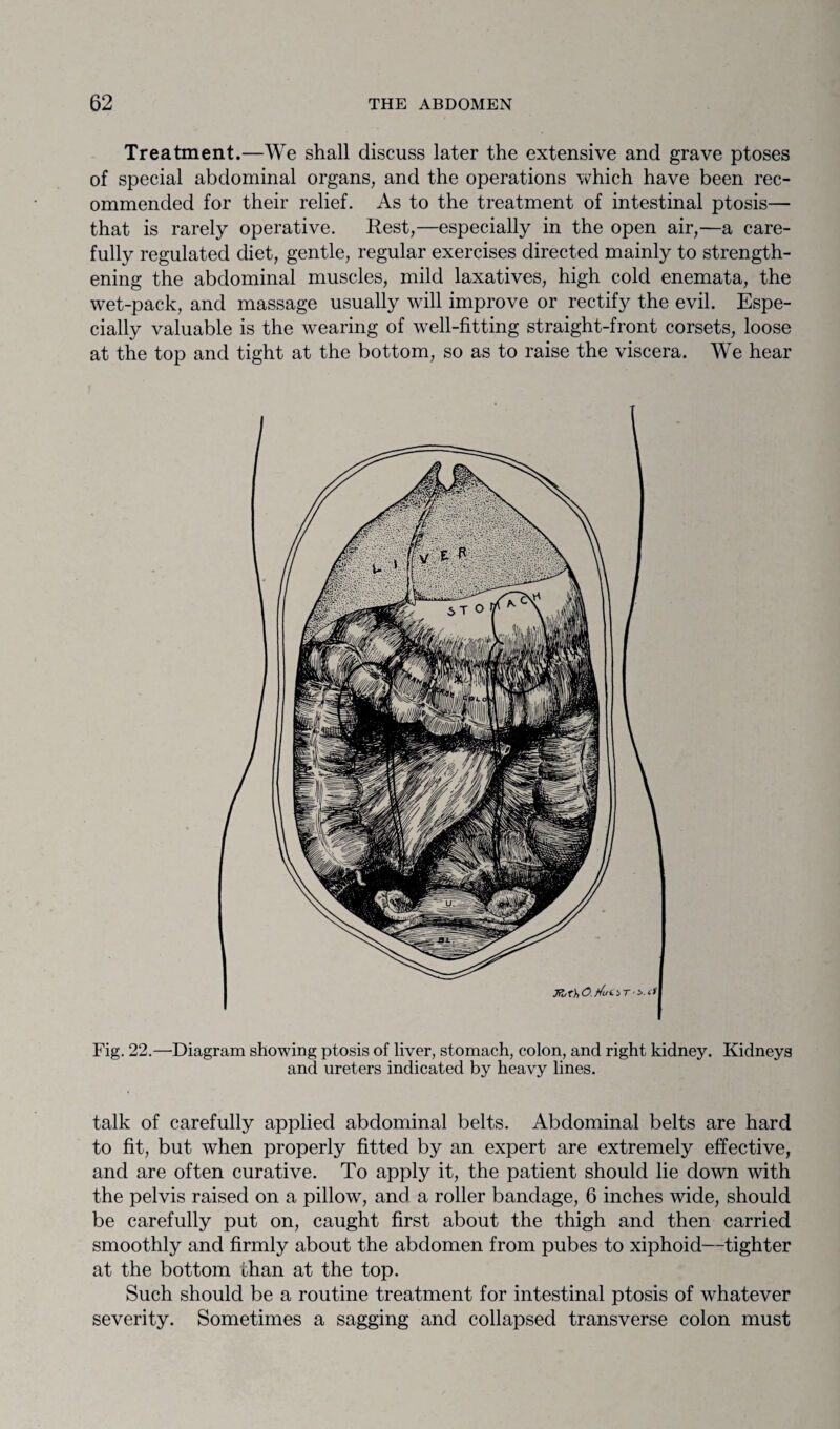 Treatment.—We shall discuss later the extensive and grave ptoses of special abdominal organs, and the operations which have been rec¬ ommended for their relief. As to the treatment of intestinal ptosis— that is rarely operative. Rest,—especially in the open air,—a care¬ fully regulated diet, gentle, regular exercises directed mainly to strength¬ ening the abdominal muscles, mild laxatives, high cold enemata, the wet-pack, and massage usually will improve or rectify the evil. Espe¬ cially valuable is the wearing of well-fitting straight-front corsets, loose at the top and tight at the bottom, so as to raise the viscera. We hear Fig. 22.—Diagram showing ptosis of liver, stomach, colon, and right kidney. Kidneys and ureters indicated by heavy lines. talk of carefully applied abdominal belts. Abdominal belts are hard to fit, but when properly fitted by an expert are extremely effective, and are often curative. To apply it, the patient should lie down with the pelvis raised on a pillow, and a roller bandage, 6 inches wide, should be carefully put on, caught first about the thigh and then carried smoothly and firmly about the abdomen from pubes to xiphoid—tighter at the bottom than at the top. Such should be a routine treatment for intestinal ptosis of whatever severity. Sometimes a sagging and collapsed transverse colon must