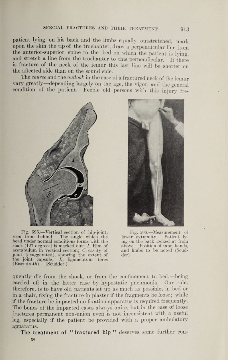 patient lying on his back and the limbs equally outstretched, mark upon the skin the tip of the trochanter, draw a perpendicular line from the anterior-superior spine to the bed on which the patient is lying, and stretch a line from the trochanter to this perpendicular. If there is fracture of the neck of the femur this last line will be shorter on the affected side than on the sound side. The course and the outlook in the case of a fractured neck of the femur vary greatly—depending largely on the age, the vigor, and the general condition of the patient. Feeble old persons with this injury fre- Fig. 595.—Vertical section of hip-joint, seen from behind. The angle which the head under normal conditions forms with the shaft (127 -degrees) is marked out: I, Rim of acetabulum in vertical section; C, cavity of joint (exaggerated), showing the extent of the joint capsule; L, ligamentum teres (Eisendrath). (Scudder.) Fig. 596.—Measurement of lower extremity. Patient ly¬ ing on the back looked at from above. Position of tape, hands, and limbs to be noted (Scud¬ der). quently die from the shock, or from the confinement to bed,—being carried off in the latter case by hypostatic pneumonia. Our rule, therefore, is to have old patients sit up as much as possible, in bed or in a chair, fixing the fracture in plaster if the fragments be loose; while if the fracture be impacted no fixation apparatus is required frequently. The bones of the impacted cases always unite, but in the case of loose fractures permanent non-union even is not inconsistent with a useful leg, especially if the patient be provided with a proper ambulatory apparatus. The treatment of “ fractured hip ” deserves some further con- 58