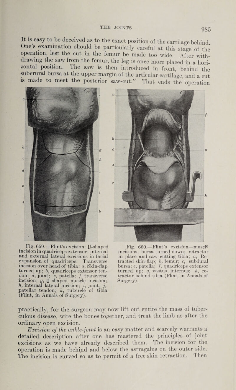 It is easy to be deceived as to the exact position of the cartilage behind. One s examination should be particularly careful at this stage of the operation, lest the cut in the femur be made too wide. After with¬ drawing the saw from the femur, the leg is once more placed in a hori¬ zontal position. The saw is then introduced in front, behind the subcrural bursa at the upper margin of the articular cartilage and a cut is made to meet the posterior saw-cut.” That ends the' operation Fig. 659.—Flint’s excision. U-shaped incision in quadriceps extensor; internal and external lateral excisions in facial expansion of quadriceps. Transverse incision over head of tibia: a, Skin-flap turned up; b, quadriceps extensor ten¬ don; d, joint; e, patella; /, transverse incision; g, U shaped muscle incision; h, internal lateral incision; i, joint; j, patellar tendon; k, tubercle of tibia (Flint, in Annals of Surgery). Fig. 660.—Flint’s excision—muscle incisions; bursa turned down; retractor in place and saw cutting tibia; a, Re¬ tracted skin-flap; b, femur; c, subdural bursa; e, patella; /, quadriceps extensor turned up; g, vastus internus; h, re¬ tractor behind tibia (Flint, in Annals of Surgery). practically, for the surgeon may now lift out entire the mass of tuber¬ culous disease, wire the bones together, and treat the limb as after the ordinary open excision. Excision of the ankle-joint is an easy matter and scarcely warrants a detailed description after one has mastered the principles of joint excisions as we have already described them. The incision for the operation is made behind and below the astragalus on the outer side. The incision is curved so as to permit of a free skin retraction. Then