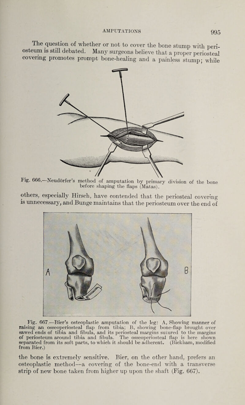 The question of whether or not to cover the bone stump with peri¬ osteum is still debated. Many surgeons believe that a proper periosteal coveiing piomotes prompt bone-healing and a painless stump; while Fig. 666.—Neudorfer’s method of amputation by primary division of the bone before shaping the flaps (Matas). others, especially Hirsch, have contended that the periosteal covering is unnecessary, and Bunge maintains that the periosteum over the end of Fig. 667.—Bier’s osteoplastic amputation of the leg: A, Showing manner of raising an osseoperiosteal flap from tibia; B, showing bone-flap brought over sawed ends of tibia and fibula, and its periosteal margins sutured to the margins of periosteum around tibia and fibula. The osseoperiosteal flap is here shown separated from its soft parts, to which it should be adherent. (Bickham, modified from Bier.) the bone is extremely sensitive. Bier, on the other hand, prefers an osteoplastic method—a covering of the bone-end with a transverse strip of new bone taken from higher up upon the shaft (Fig. 667).