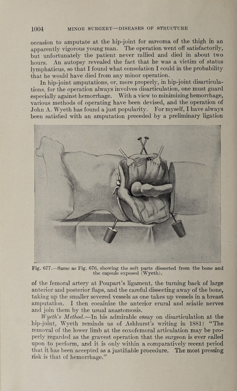 occasion to amputate at the hip-joint for sarcoma of the thigh in an apparently vigorous young man. The operation went off satisfactorily, but unfortunately the patient never rallied and died in about two hours. An autopsy revealed the fact that he was a victim of status lymphaticus, so that I found what consolation I could in the probability that he would have died from any minor operation. In hip-joint amputations, or, more properly, in hip-joint disarticula¬ tions, for the operation always involves disarticulation, one must guard especially against hemorrhage. With a view to minimizing hemorrhage, various methods of operating have been devised, and the operation of John A. Wyeth has found a just popularity. For myself, I have always been satisfied with an amputation preceded by a preliminary ligation Fig. 677.—Same as Fig. 676, showing the soft parts dissected from the bone and the capsule exposed (Wyeth). of the femoral artery at Poupart’s ligament, the turning back of large anterior and posterior flaps, and the careful dissecting away of the bone, taking up the smaller severed vessels as one takes up vessels in a breast amputation. I then cocainize the anterior crural and sciatic nerves and join them by the usual anastomosis. Wyeth's Method.—In his admirable essay on disarticulation at the hip-joint, Wyeth reminds us of Ashhurst’s writing in 1881: “The removal of the lowrer limb at the coxofemoral articulation may be pro¬ perly regarded as the gravest operation that the surgeon is ever called upon to perform, and it is only within a comparative^ recent period that it has been accepted as a justifiable procedure. The most pressing risk is that of hemorrhage.”