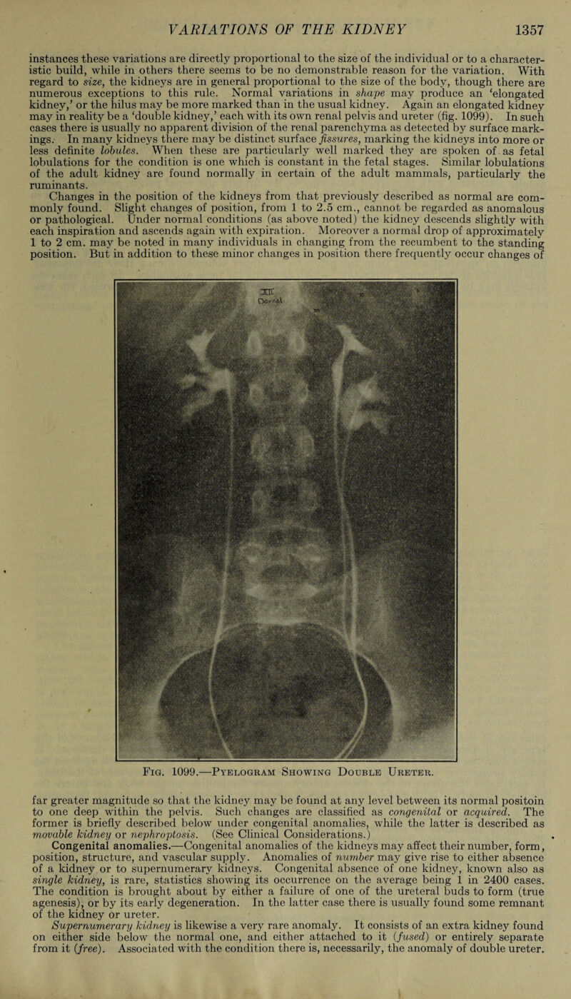 instances these variations are directly proportional to the size of the individual or to a character¬ istic build, while in others there seems to be no demonstrable reason for the variation. With regard to size, the kidneys are in general proportional to the size of the body, though there are numerous exceptions to this rule. Normal variations in shape may produce an ‘elongated kidney/ or the hilus may be more marked than in the usual kidney. Again an elongated kidney may in reality be a ‘double kidney/ each with its own renal pelvis and ureter (fig. 1099). In such cases there is usually no apparent division of the renal parenchyma as detected by surface mark¬ ings. In many kidneys there may be distinct surface fissures, marking the kidneys into more or less definite lobules. When these are particularly well marked they are spoken of. as fetal lobulations for the condition is one which is constant in the fetal stages. Similar lobulations of the adult kidney are found normally in certain of the adult mammals, particularly the ruminants. Changes in the position of the kidneys from that previously described as normal are com¬ monly found. Slight changes of position, from 1 to 2.5 cm., cannot be regarded as anomalous or pathological. Under normal conditions (as above noted) the kidney descends slightly with each inspiration and ascends again with expiration. Moreover a normal drop of approximately 1 to 2 cm. may be noted in many individuals in changing from the recumbent to the standing position. But in addition to these minor changes in position there frequently occur changes of Fig. 1099.—Pyelogram Showing Double Ureter. far greater magnitude so that the kidney may be found at any level between its normal positoin to one deep within the pelvis. Such changes are classified as congenital or acquired. The former is briefly described below under congenital anomalies, while the latter is described as movable kidney or nephroptosis. (See Clinical Considerations.) Congenital anomalies.—Congenital anomalies of the kidneys may affect their number, form, position, structure, and vascular supply. Anomalies of number may give rise to either absence of a kidney or to supernumerary kidneys. Congenital absence of one kidney, known also as single kidney, is rare, statistics showing its occurrence on the average being 1 in 2400 cases. The condition is brought about by either a failure of one of the ureteral buds to form (true agenesis), or by its early degeneration. In the latter case there is usually found some remnant of the kidney or ureter. Supernumerary kidney is likewise a very rare anomaly. It consists of an extra kidney found on either side below the normal one, and either attached to it (fused) or entirely separate from it (free). Associated with the condition there is, necessarily, the anomaly of double ureter.