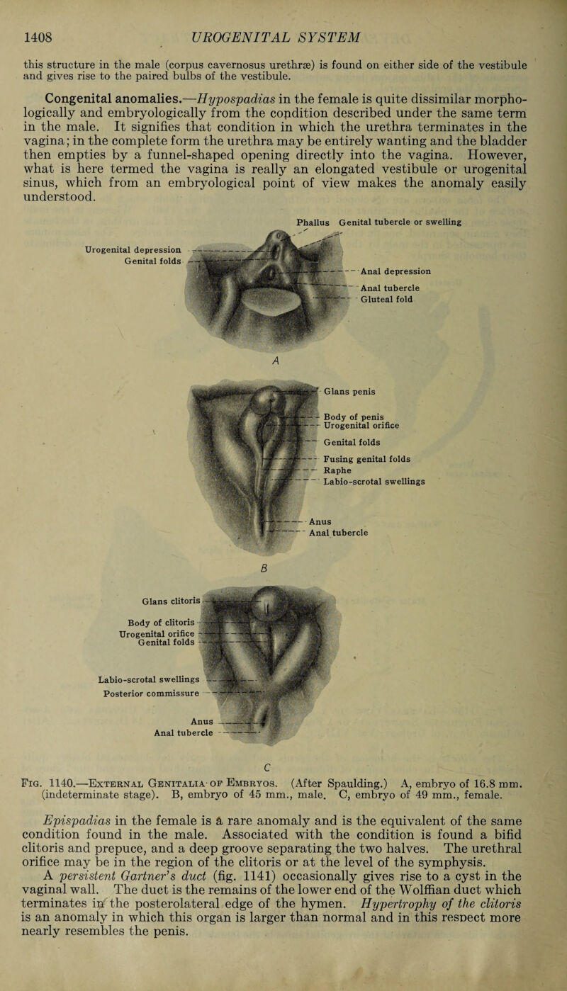 this structure in the male (corpus cavernosus urethrse) is found on either side of the vestibule and gives rise to the paired bulbs of the vestibule. Congenital anomalies.—Hypospadias in the female is quite dissimilar morpho¬ logically and embryologically from the copdition described under the same term in the male. It signifies that condition in which the urethra terminates in the vagina; in the complete form the urethra may be entirely wanting and the bladder then empties by a funnel-shaped opening directly into the vagina. However, what is here termed the vagina is really an elongated vestibule or urogenital sinus, which from an embryological point of view makes the anomaly easily understood. Phallus Genital tubercle or swelling Urogenital depression Genital folds -Anal depression 'Anal tubercle Gluteal fold Gians penis Body of penis Urogenital orifice Genital folds Fusing genital folds Raphe Labio-scrotal swellings Anus  Anal tubercle B Labio-scrotal swellings Posterior commissure Anus Anal tubercle Gians clitoris Body of clitoris Urogenital orifice Genital folds C Fig. 1140.—External Genitalia-of Embryos. (After Spaulding.) A, embryo of 16.8 mm. (indeterminate stage). B, embryo of 45 mm., male. C, embryo of 49 mm., female. Epispadias in the female is A rare anomaly and is the equivalent of the same condition found in the male. Associated with the condition is found a bifid clitoris and prepuce, and a deep groove separating the two halves. The urethral orifice may be in the region of the clitoris or at the level of the symphysis. A persistent Gartner’s duct (fig. 1141) occasionally gives rise to a cyst in the vaginal wall. The duct is the remains of the lower end of the Wolffian duct which terminates in the posterolateral edge of the hymen. Hypertrophy of the clitoris is an anomaly in which this organ is larger than normal and in this respect more nearly resembles the penis.