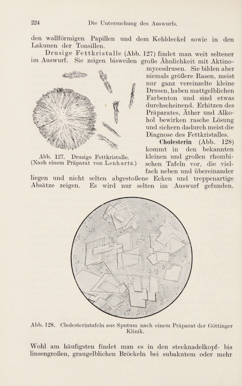 den wallförmigen Papillen und dem Kehldeckel sowie in den Lakunen der Tonsillen. Drüsige Fettkristalle (Abb. 127) findet man weit seltener im Auswurf. Sie zeigen bisweilen große Ähnlichkeit mit Aktino- mycesdrusen. Sie bilden aber niemals größere Rasen, meist nur ganz vereinzelte kleine Drusen, haben mattgelblichen Farbenton und sind etwas durchscheinend. Erhitzen des Präparates, Äther und Alko¬ hol bewirken rasche Lösung und sichern dadurch meist die Diagnose des Fettkristalles. Cholesterin (Abb. 128) kommt in den bekannten kleinen und großen rhombi¬ schen Tafeln vor, die viel¬ fach neben und übereinander hegen und nicht selten abgestoßene Ecken und treppenartige Absätze zeigen. Es wird nur selten im Auswurf gefunden. Abb. 128. Cholesterintafeln aus Sputum nach einem Präparat der Göttinger Klinik. Wohl am häufigsten findet man es in den Stecknadelkopf- bis linsengroßen, graugelblichen Bröckeln bei subakutem oder mehr Abb. 127. Drüsige Fettkristalle. (Nach einem Präparat von Lenhartz.)