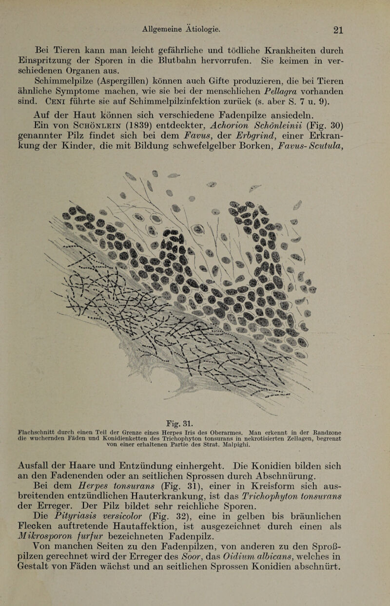 Bei Tieren kann man leicht gefährliche und tödliche Krankheiten durch Einspritzung der Sporen in die Blutbahn hervorrufen. Sie keimen in ver¬ schiedenen Organen aus. Schimmelpilze (Aspergillen) können auch Gifte produzieren, die bei Tieren ähnliche Symptome machen, wie sie bei der menschlichen Pellagra vorhanden sind. Cent führte sie auf Schimmelpilzinfektion zurück (s. aber S. 7 u. 9). Auf der Haut können sich verschiedene Fadenpilze ansiedeln. Ein von Schönlein (1839) entdeckter, Achorion Schönleinii (Fig. 30) genannter Pilz findet sich bei dem Favus, der Erbgrind, einer Erkran¬ kung der Kinder, die mit Bildung schwefelgelber Borken, Favus- Scutula, .. X Fig. 31. Flachschnitt durch einen Teil der Grenze eines Herpes Iris des Oberarmes. Man erkennt in der Kandzone die wuchernden Fäden und Konidienketten des Trichophyton tonsurans in nekrotisierten Zellagen, begrenzt von einer erhaltenen Partie des Strat. Malpighi. Ausfall der Haare und Entzündung einhergeht. Die Konidien bilden sich an den Fadenenden oder an seitlichen Sprossen durch Abschnürung. Bei dem Herpes tonsurans (Fig. 31), einer in Kreisform sich aus¬ breitenden entzündlichen Hauterkrankung, ist das Trichophyton tonsurans der Erreger. Der Pilz bildet sehr reichliche Sporen. Die Pityriasis versicolor (Fig. 32), eine in gelben bis bräunlichen Flecken auftretende Hautaffektion, ist ausgezeichnet durch einen als Mikrosporon furfur bezeichneten Fadenpilz. Von manchen Seiten zu den Fadenpilzen, von anderen zu den Sproß¬ pilzen gerechnet wird der Erreger des Soor, das Oidium albicans, welches in Gestalt von Fäden wächst und an seitlichen Sprossen Konidien abschnürt.