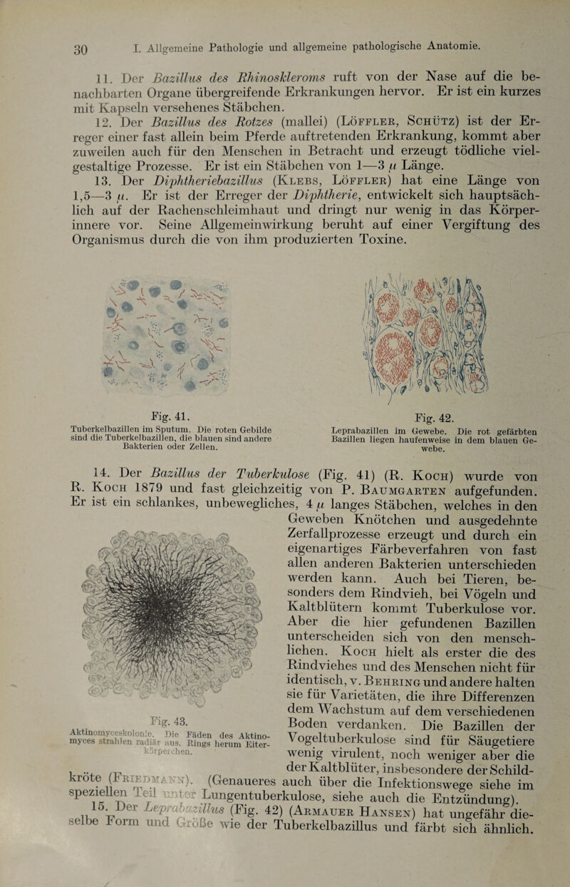 11. Der Bazillus des RhinosJcleroms ruft von der Nase auf die be¬ nachbarten Organe übergreifende Erkrankungen hervor. Er ist ein kurzes mit Kapseln versehenes Stäbchen. 12. Der Bazillus des Rotzes (mallei) (Löffler, Schütz) ist der Er¬ reger einer fast allein beim Pferde auftretenden Erkrankung, kommt aber zuweilen auch für den Menschen in Betracht und erzeugt tödliche viel¬ gestaltige Prozesse. Er ist ein Stäbchen von 1—3 p Länge. 13. Der Diphtheriebazillus (Klebs, Löffler) hat eine Länge von 1,5—3 (.i. Er ist der Erreger der Diphtherie, entwickelt sich hauptsäch¬ lich auf der Rachenschleimhaut und dringt nur wenig in das Körper¬ innere vor. Seine Allgemein Wirkung beruht auf einer Vergiftung des Organismus durch die von ihm produzierten Toxine. Pig. 41. Tuberkelbazillen im Sputum. Die roten Gebilde sind die Tuberkelbazillen, die blauen sind andere Bakterien oder Zellen. Pig. 42. Leprabazillen im Gewebe. Die rot gefärbten Bazillen liegen haufenweise in dem blauen Ge¬ webe. 14. Der Bazillus der Tuberkulose (Fig. 41) (R. Koch) wurde von R. Koch 18/9 und fast gleichzeitig von P. Baumgarten aufgefunden. Er ist ein schlankes, unbewegliches, 4 p langes Stäbchen, welches in den Geweben Knötchen und ausgedehnte Zerfallprozesse erzeugt und durch ein eigenartiges Färbe verfahren von fast allen anderen Bakterien unterschieden werden kann. Auch bei Tieren, be¬ sonders dem Rindvieh, bei Vögeln und Kaltblütern kommt Tuberkulose vor. Aber die hier gefundenen Bazillen unterscheiden sich von den mensch¬ lichen. Koch hielt als erster die des Rindviehes und des Menschen nicht für identisch, v. Behring und andere halten sie für Varietäten, die ihre Differenzen dem Wachstum auf dem verschiedenen Boden verdanken. Die Bazillen der Vogeltuberkulose sind für Säugetiere wenig virulent, noch weniger aber die ! ... ,-p, _ der Kaltblüter, insbesondere der Schild- ro ? -.[ (Genaueres auch über die Infektionswege siehe im speziellen -eil mnor Lungentuberkulose, siehe auch die Entzündung). Lu Der Leprabv.zillus (Fig. 42) (Armauer Hansen) hat ungefähr die¬ selbe Torrn und Große wie der Tuberkelbazillus und färbt sich ähnlich. ■CA yp' ' v/ rjagÄ*>'; »C'O ■ fv. . tf:)  c »‘ ;r ;■»>v ^ Pig. 43. Aktinomyceskolonie. Die Fäden des Aktino- myces strahlen radiär aus. Rings herum Eiter- körpeiehen.